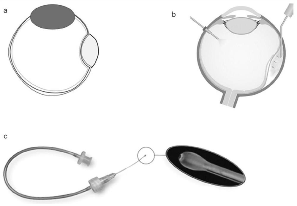 A suprachoroidal space pressurized hydrogel balloon device for rhegmatogenous retinal detachment