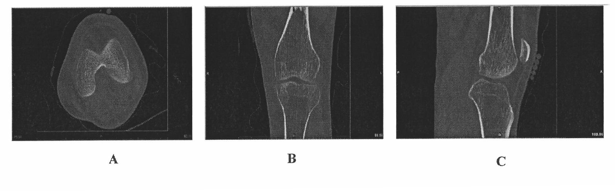 Method for positioning human body knee joint flexible motion axis in lateral femoral condyle long-axis section