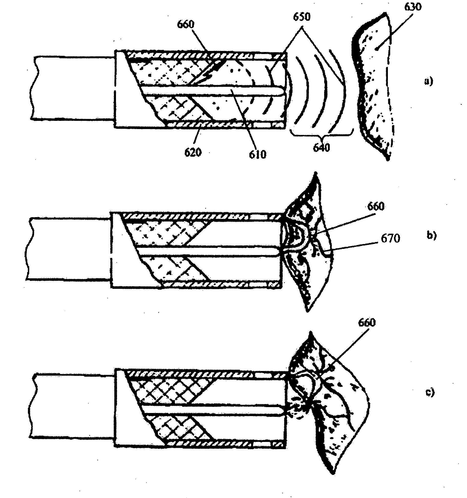 Method for intracorporeal lithotripsy fragmentation and apparatus for its implementation