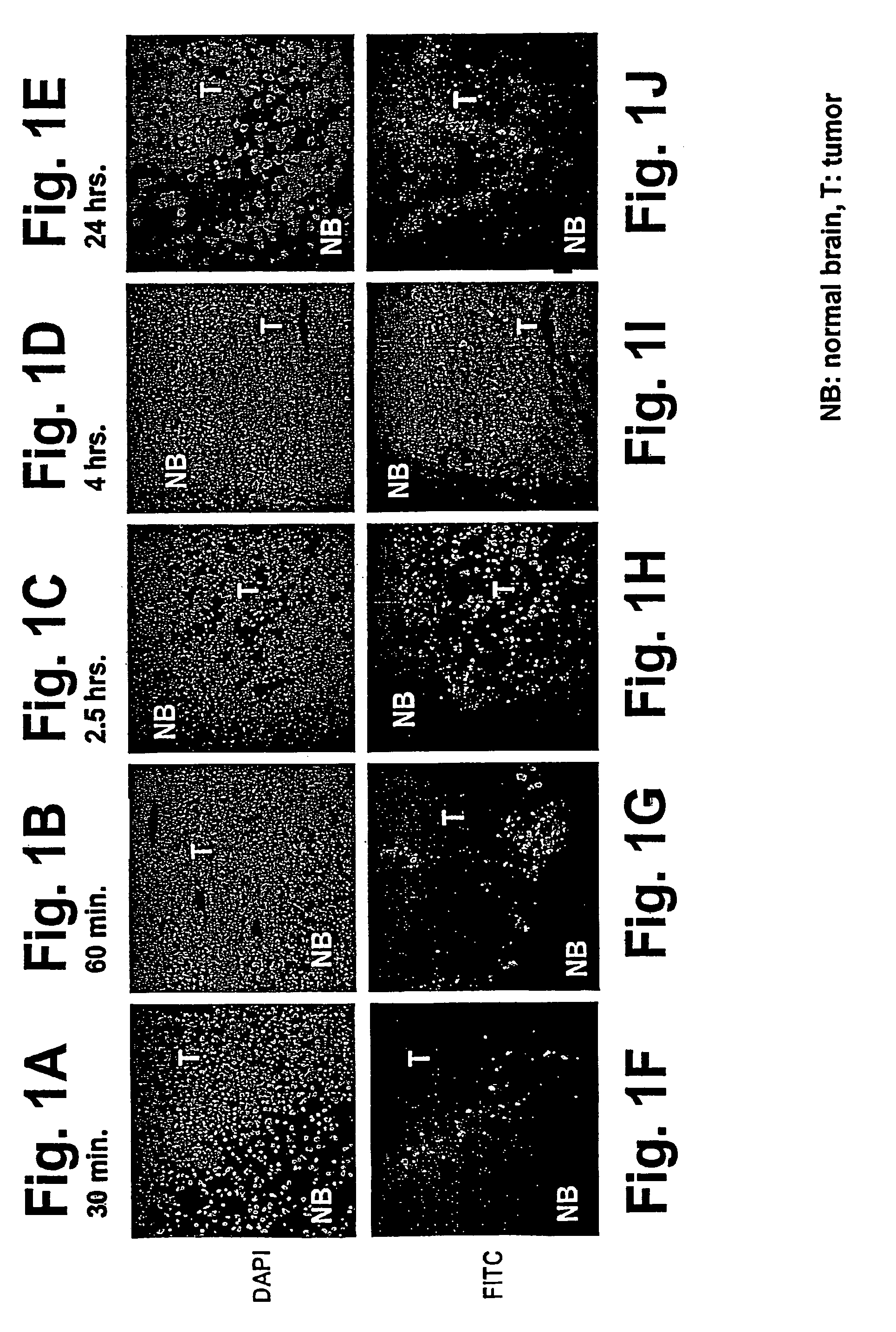 CNS-tumor treatment method and composition