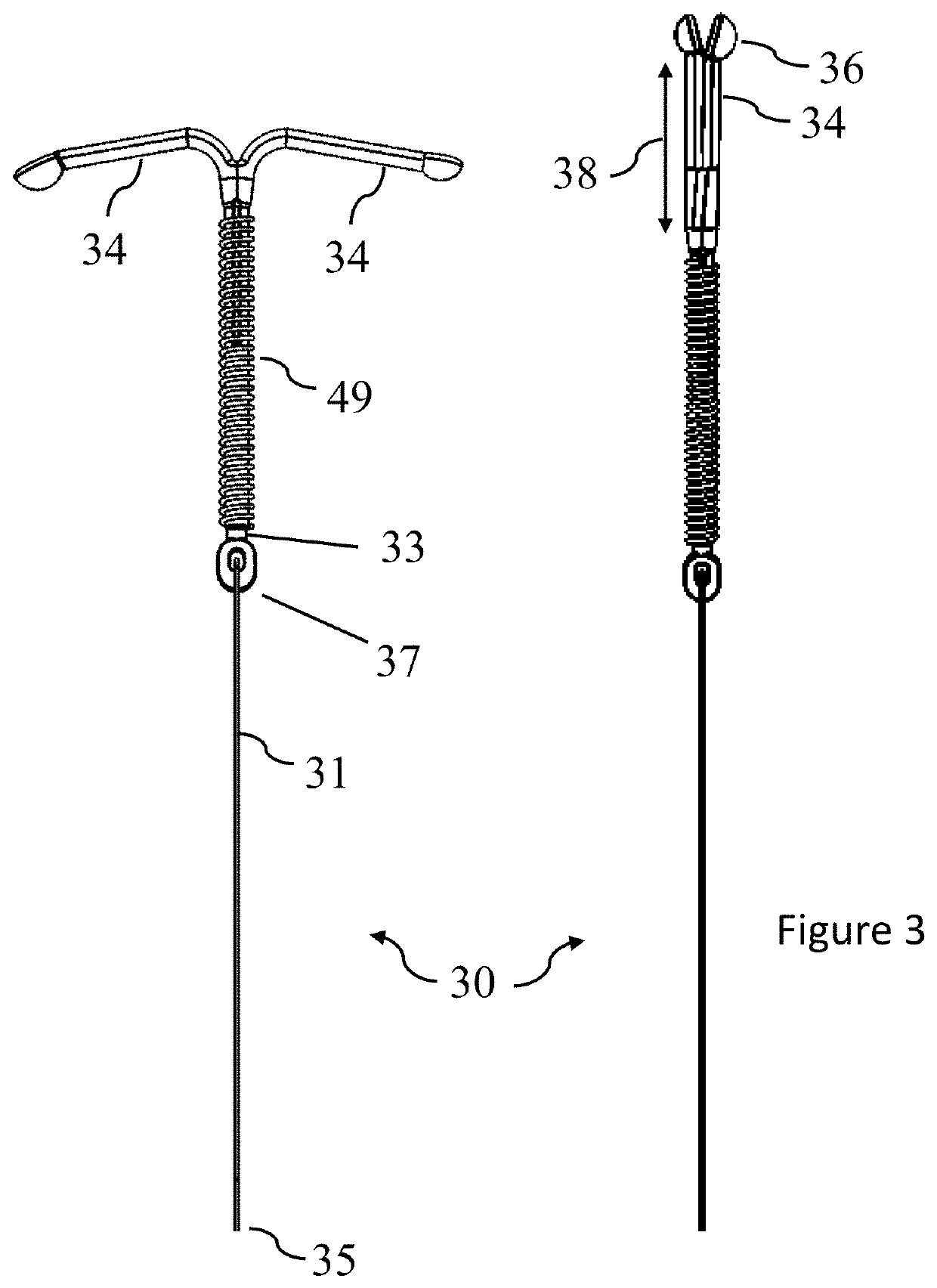 Instrument to prepare and safely place an intra-uterine device