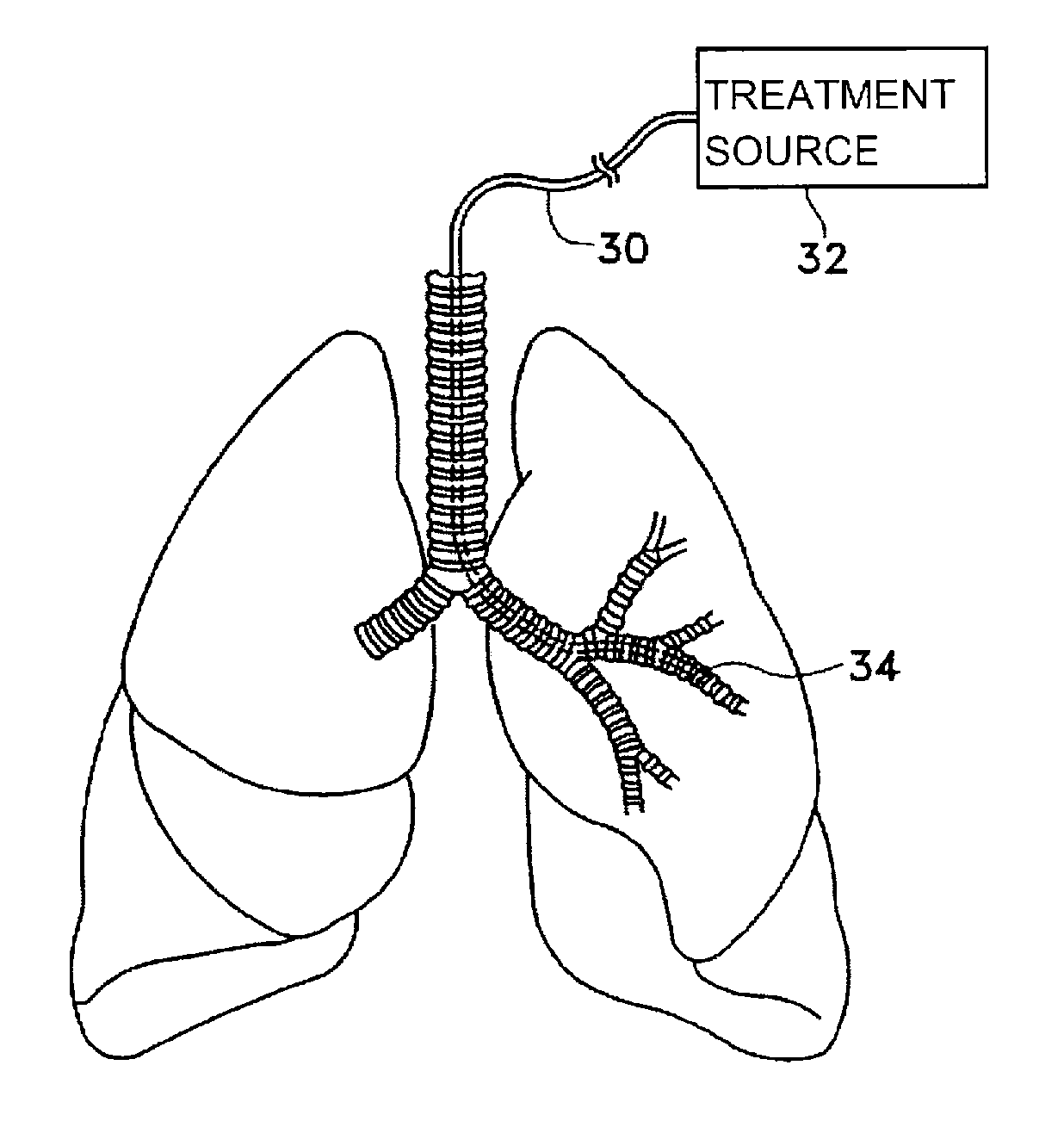 Methods of regenerating tissue in airways