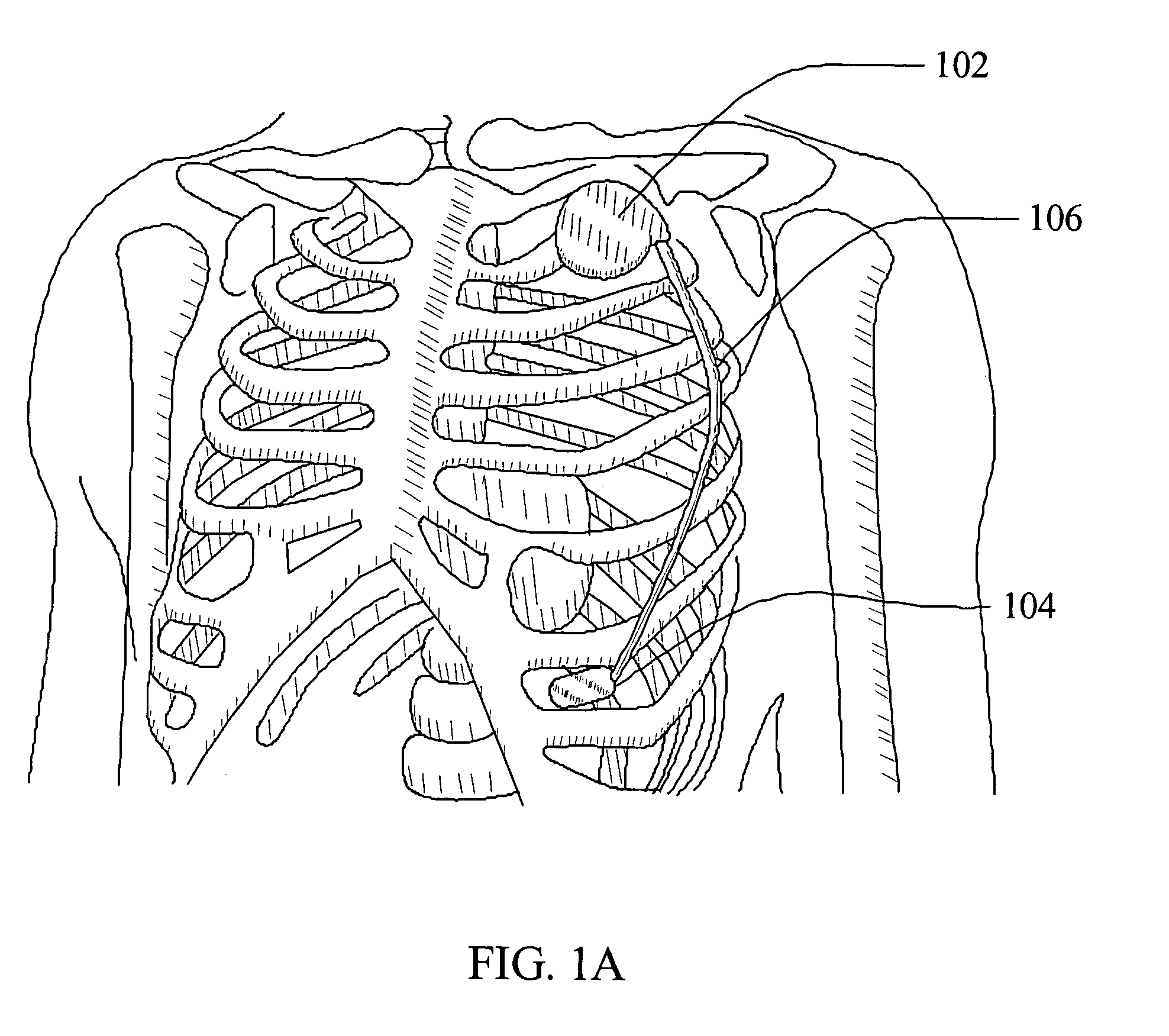 Helical fixation elements for subcutaneous electrodes