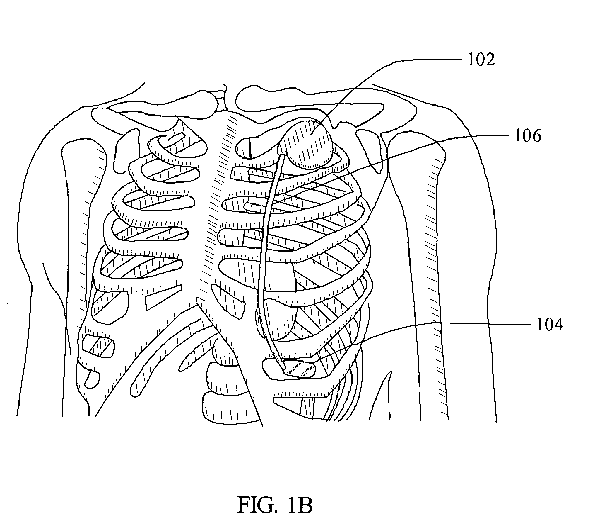 Helical fixation elements for subcutaneous electrodes