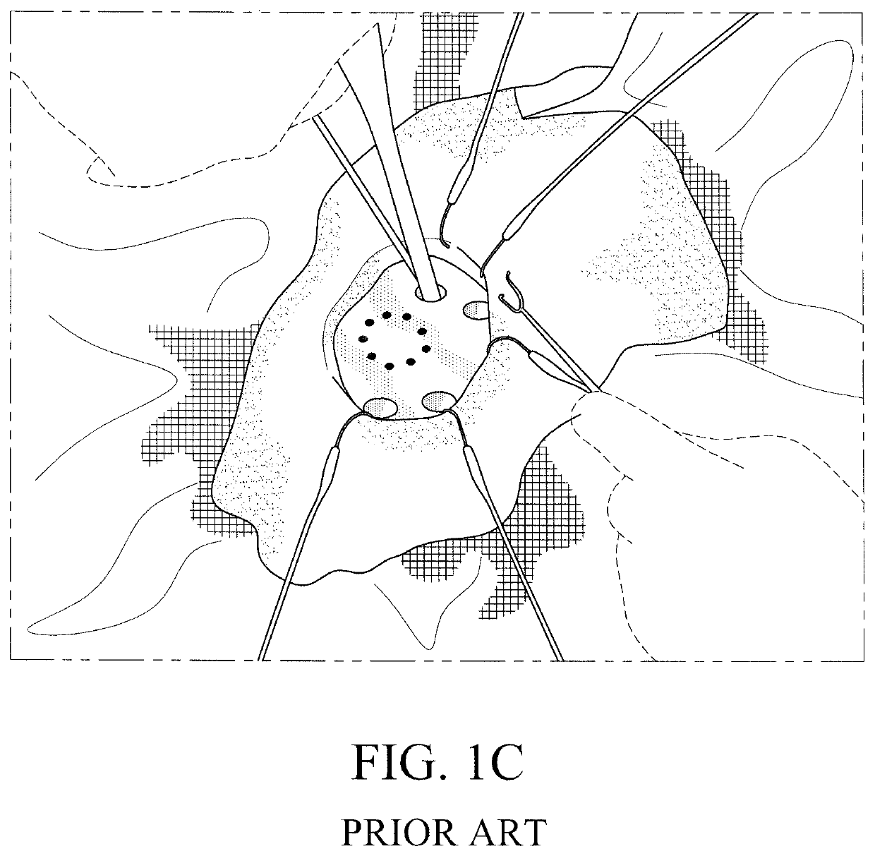Method for performing single-stage cranioplasty reconstruction with a clear custom cranial implant