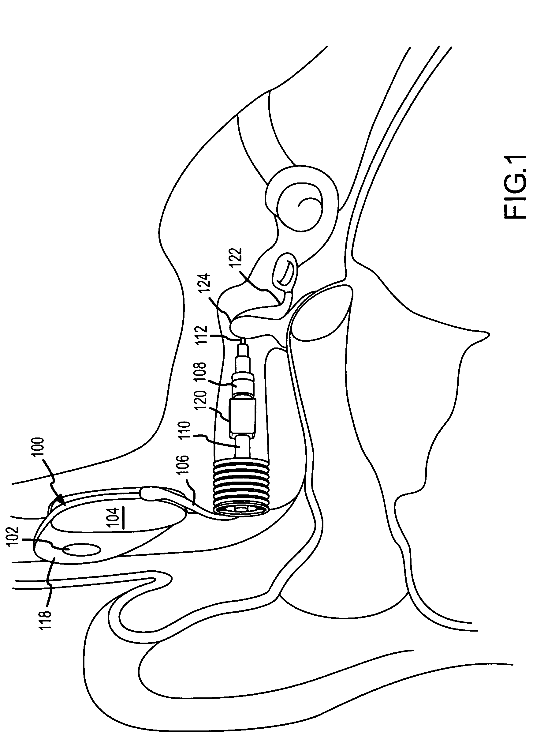 Implantable hearing aid transducer interface