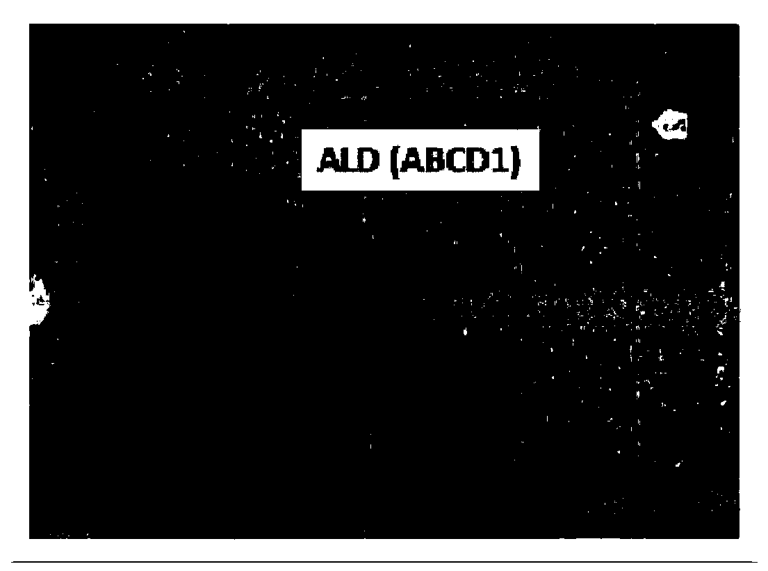 Method for treating adrenoleukodystrophy (ALD) through optimized expression of ABCD1 gene with lentiviral vector EF1alpha promoter