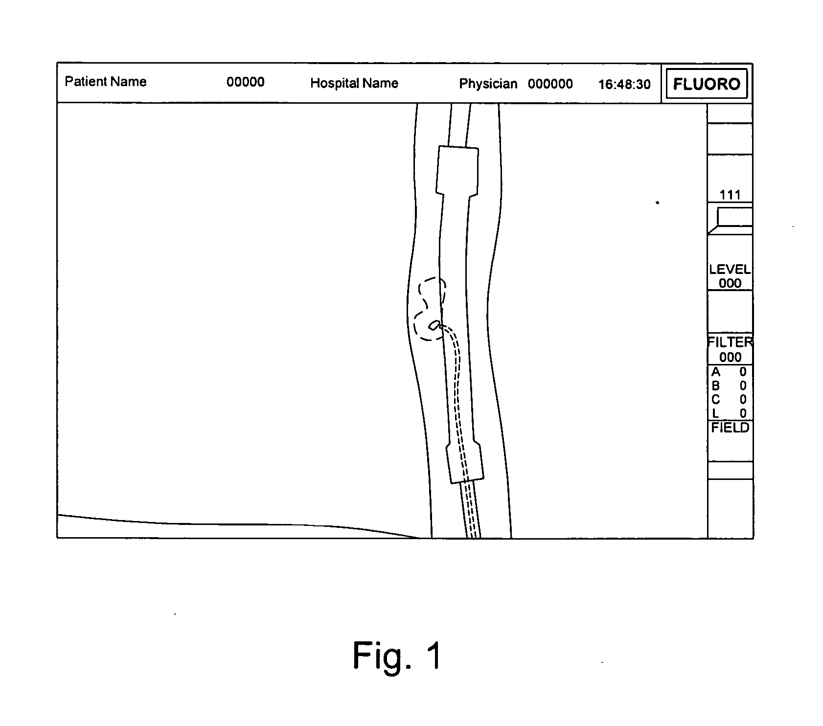 Method of Navigating Medical Devices in the Presence of Radiopaque Material