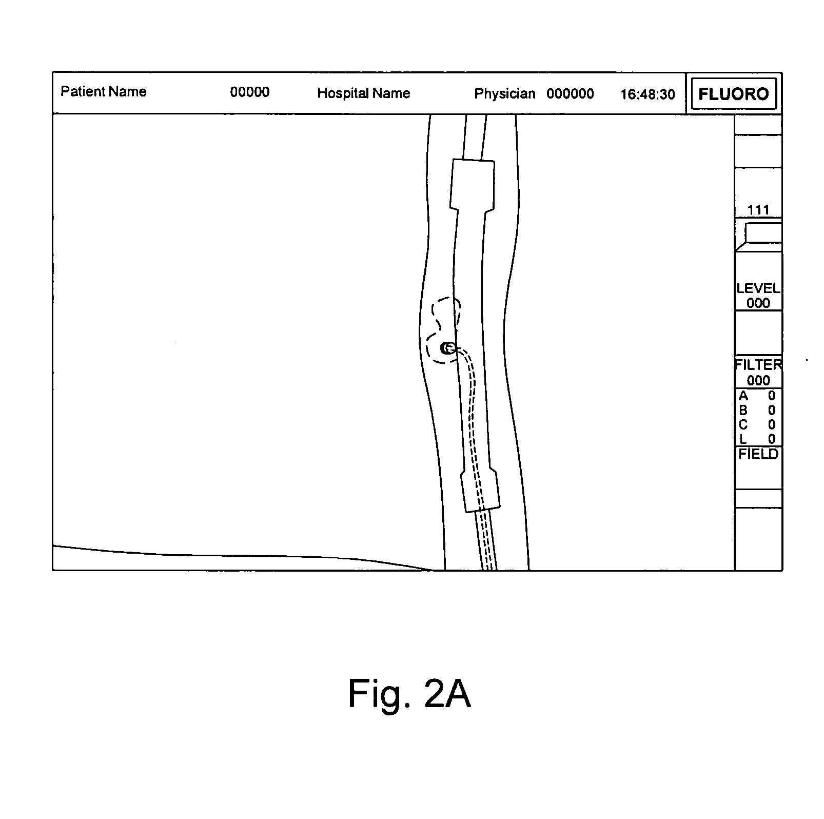 Method of Navigating Medical Devices in the Presence of Radiopaque Material
