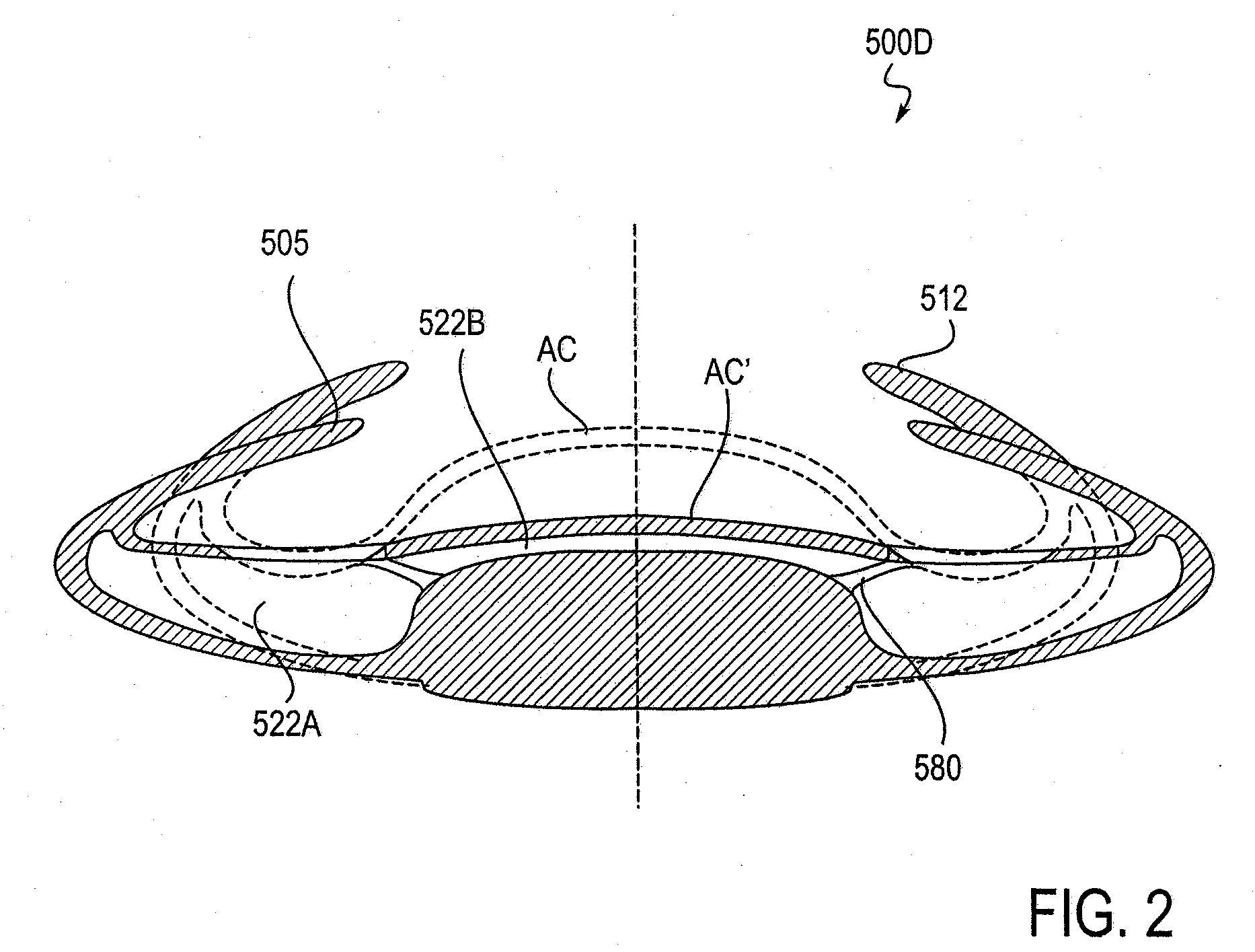 Post-Implant Accommodating Lens Modification