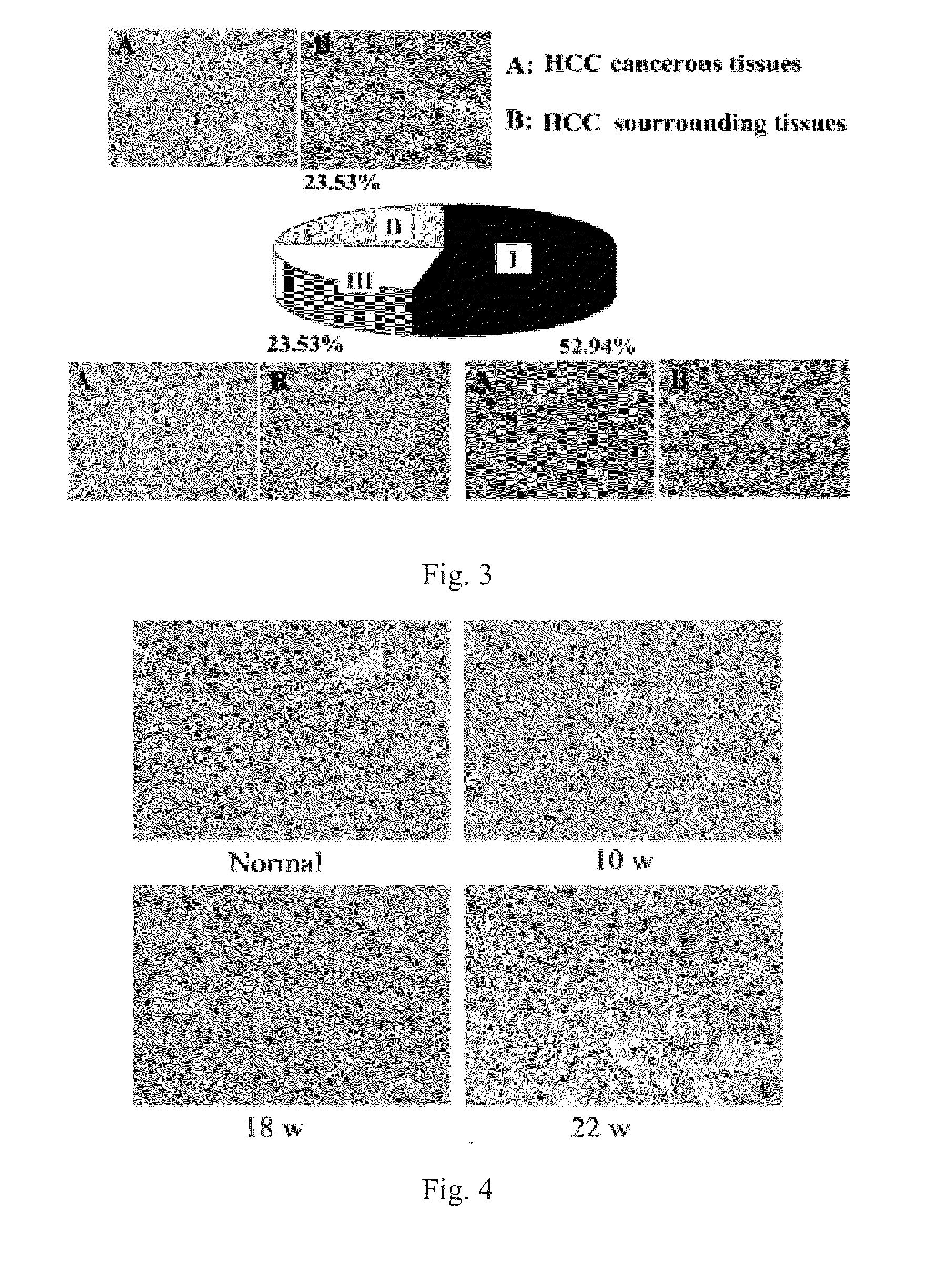 Use of hepatocyte nuclear factor 1a in preparation of drug for treating malignant solid tumor disease