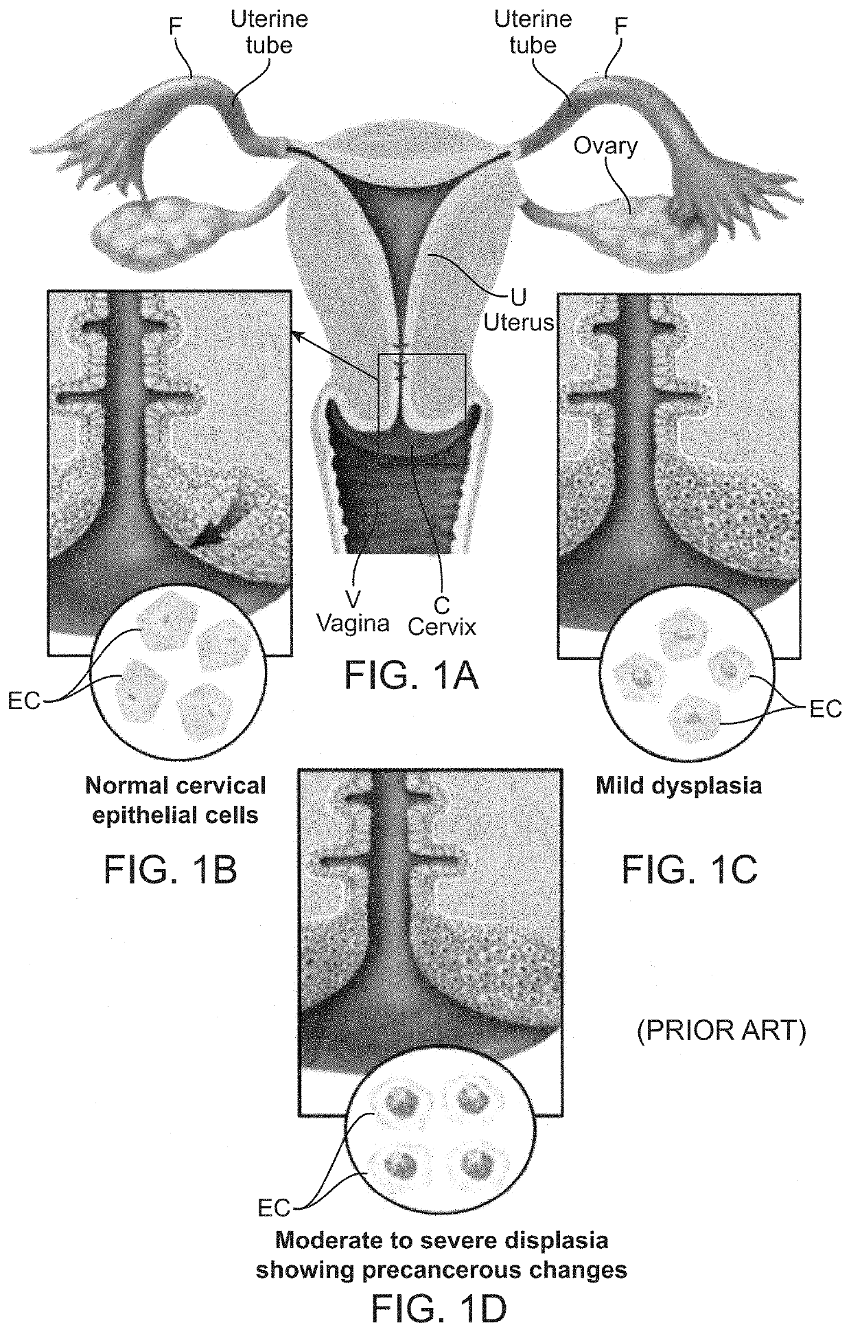 Treatment of the reproductive tract with pulsed electric fields