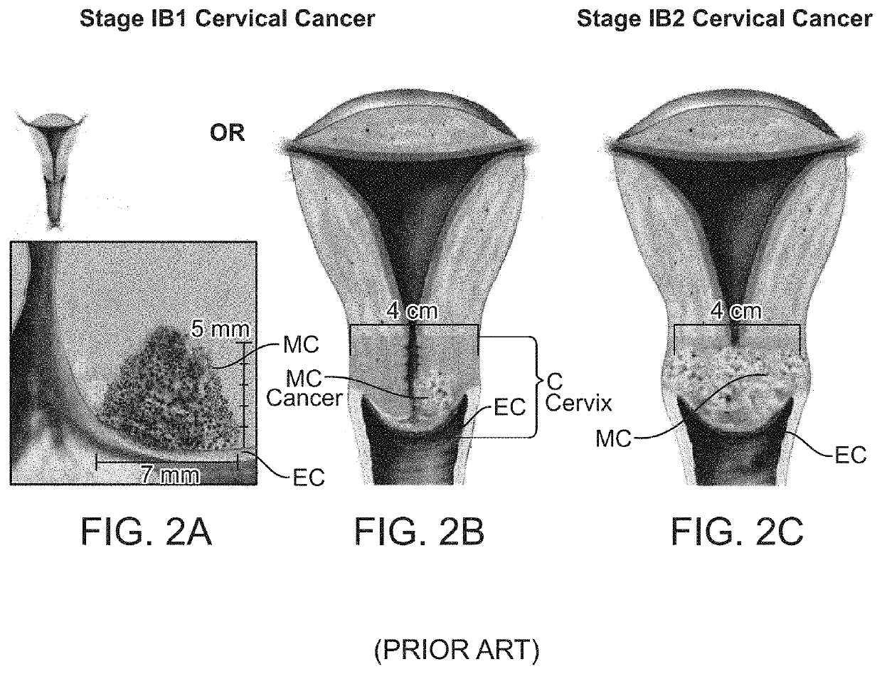 Treatment of the reproductive tract with pulsed electric fields