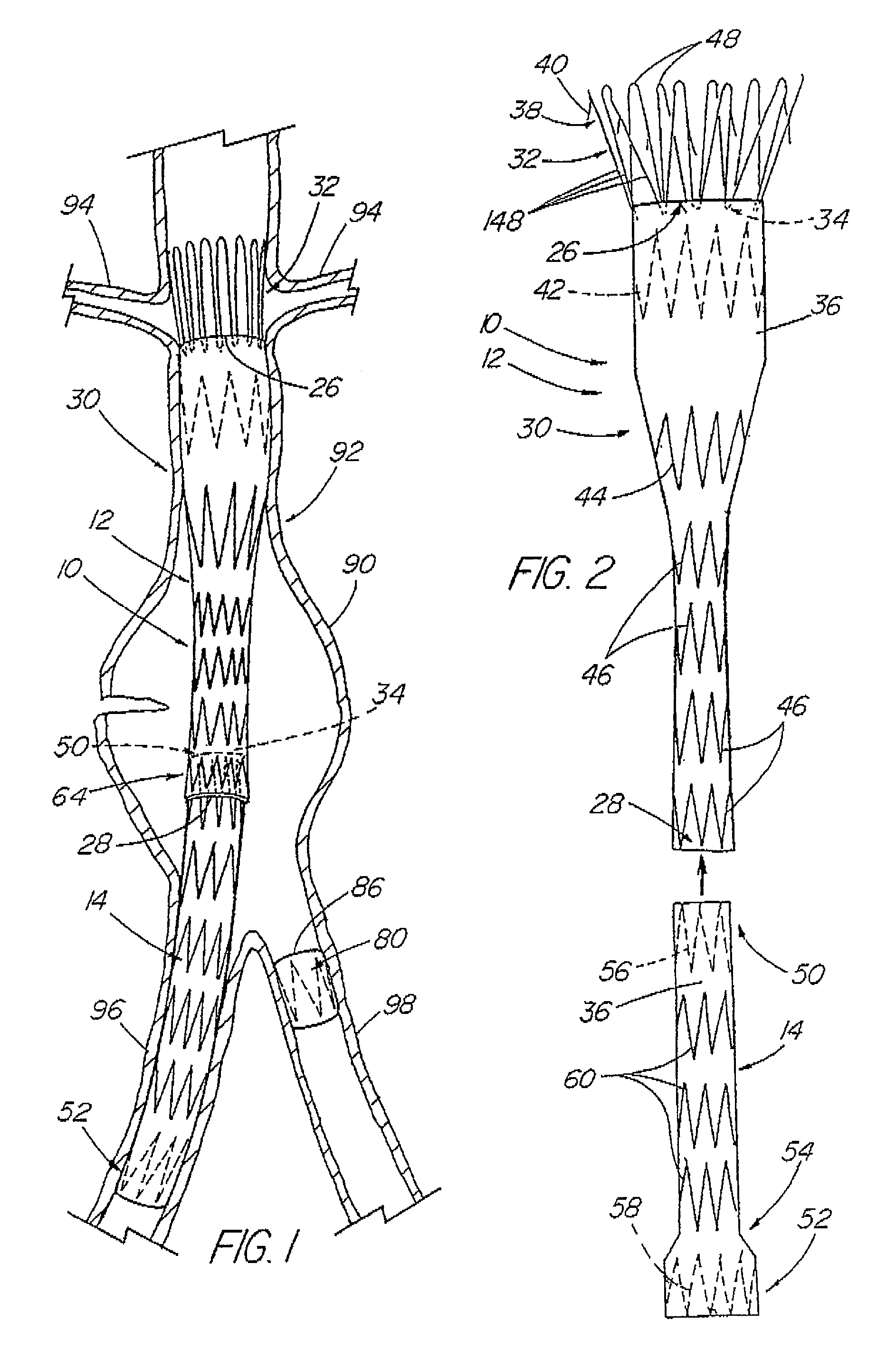 Modular stent graft assembly and use thereof
