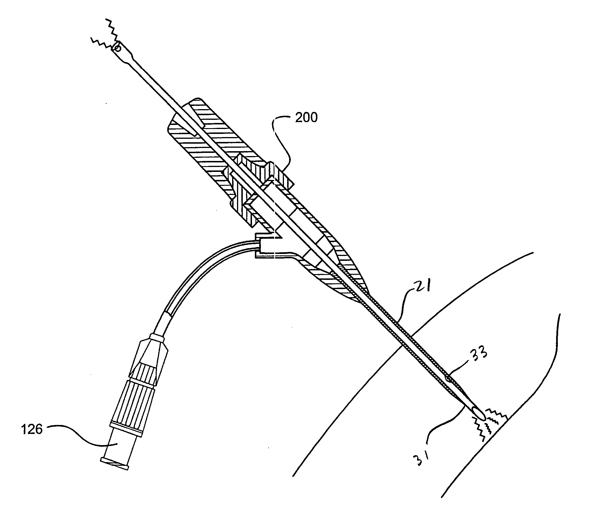 System and method of delivering local anesthesia