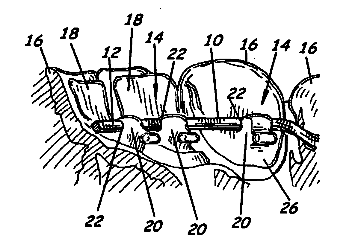 Modular system for customized orthodontic appliances