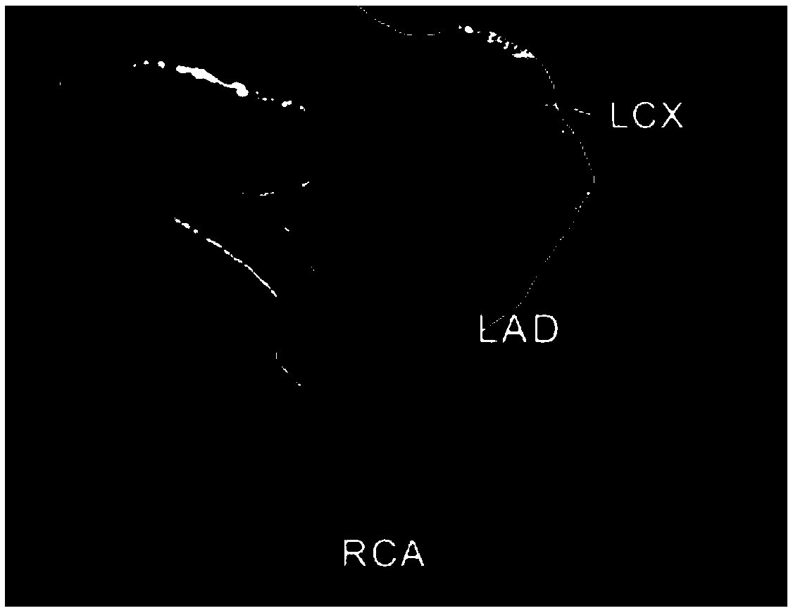 Plaque classification method for coronary CT images