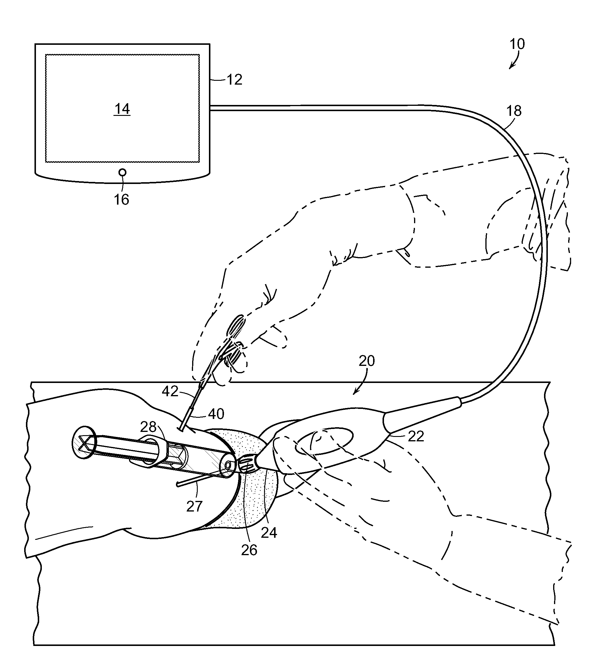 Devices and methods for minimally invasive arthroscopic surgery
