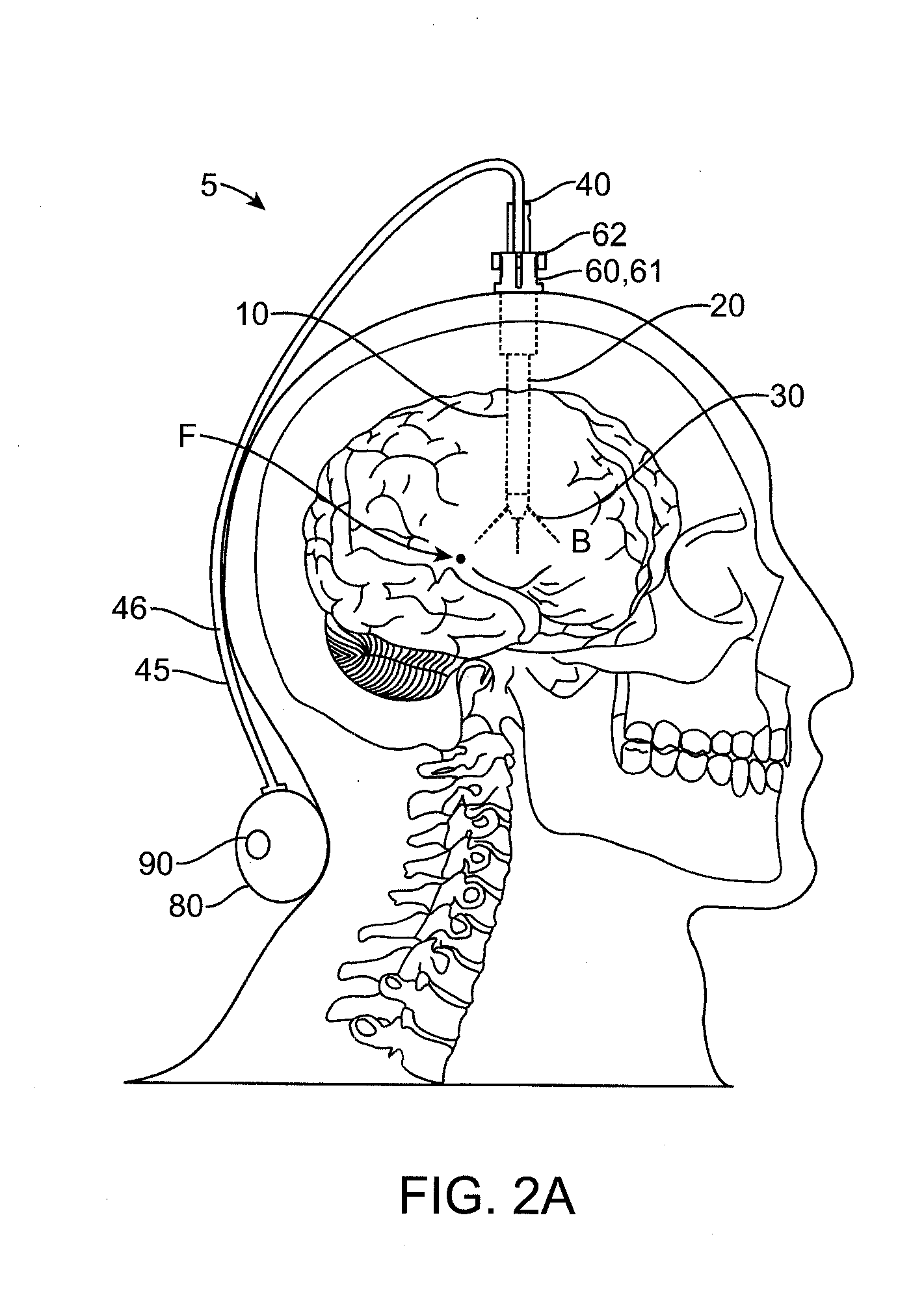 Apparatus, systems and methods for delivery of medication to the brain to treat neurological conditions