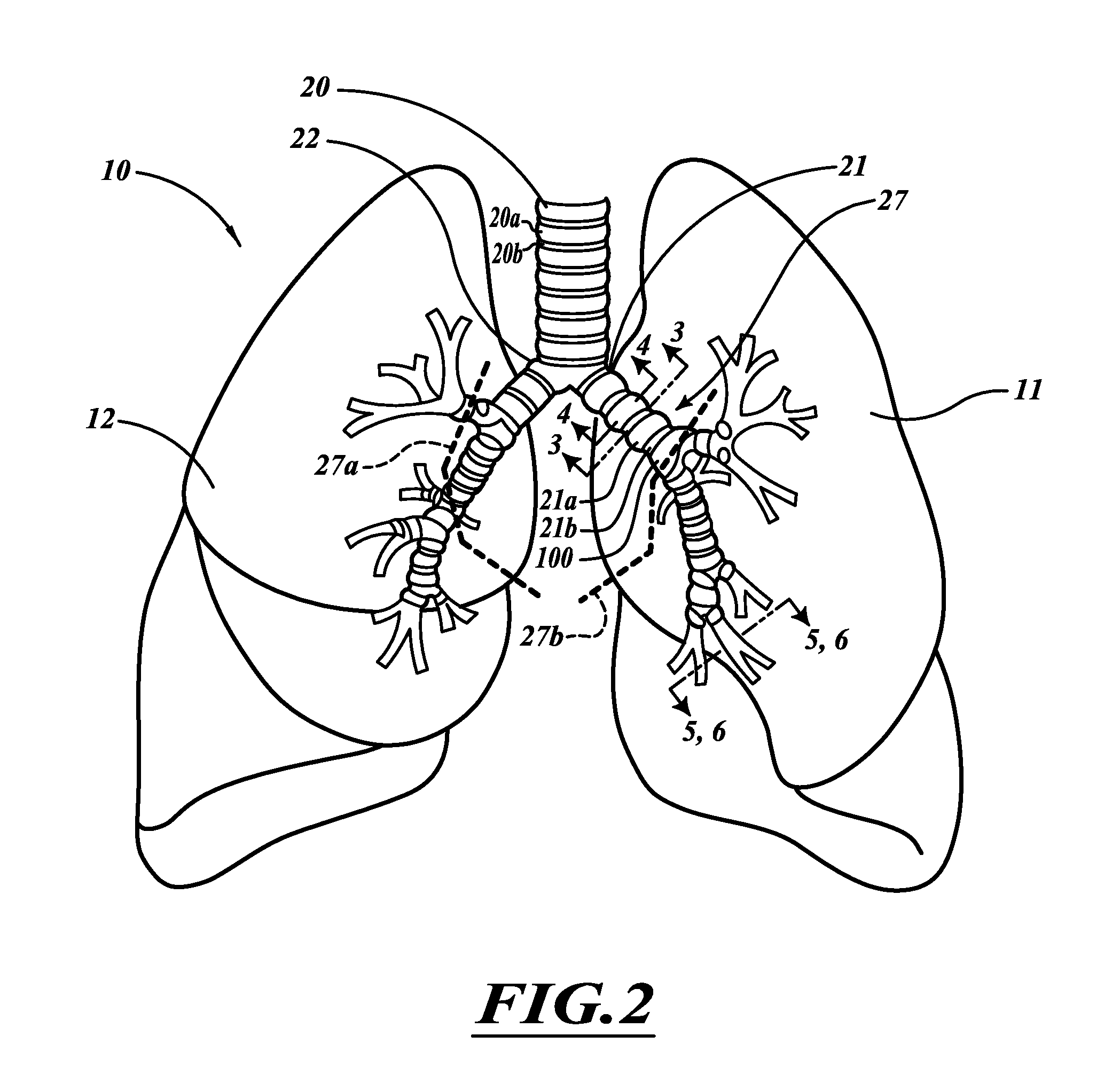 Compact delivery pulmonary treatment systems and methods for improving pulmonary function
