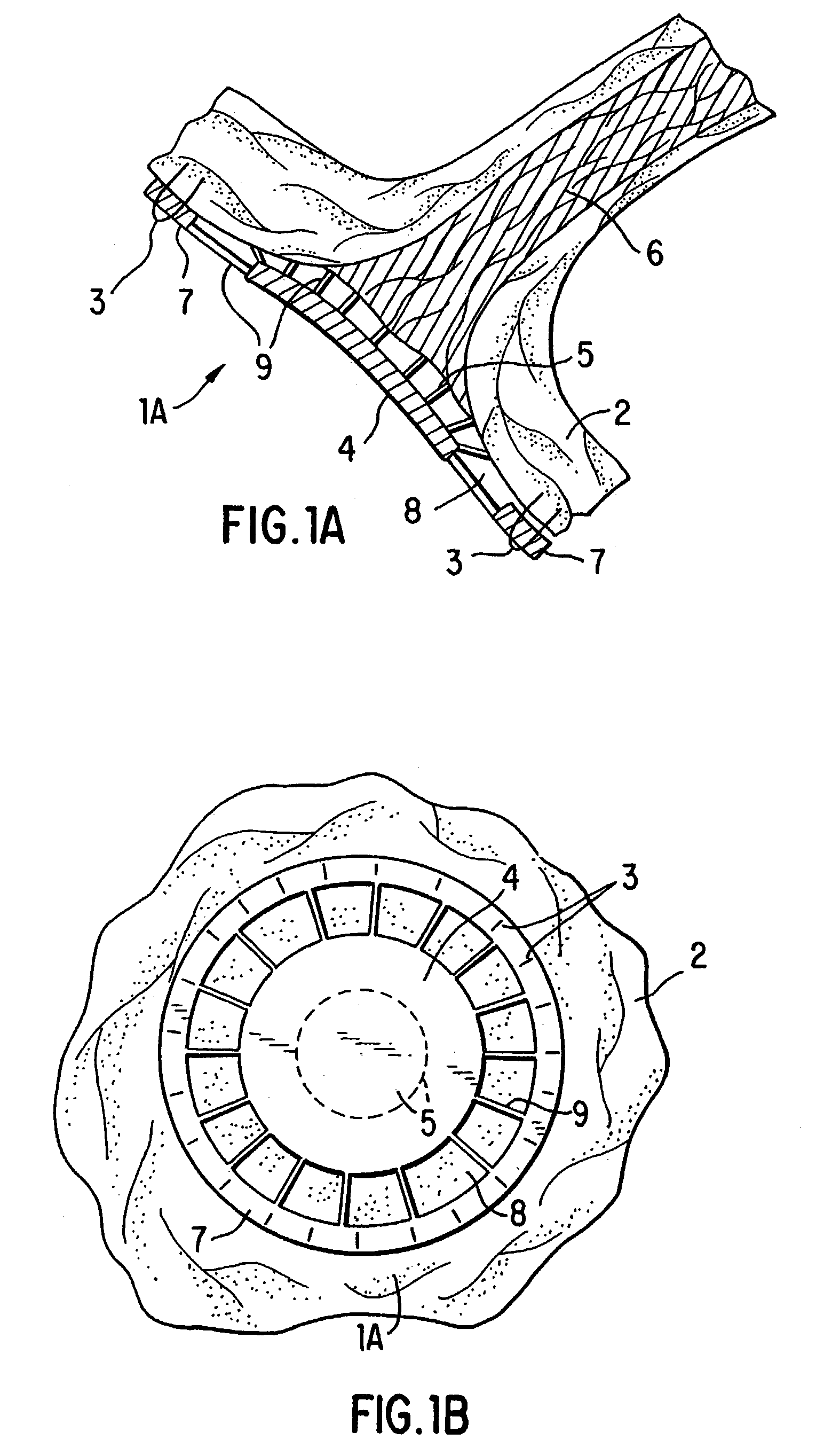 Method and devices for decreasing elevated pulmonary venous pressure