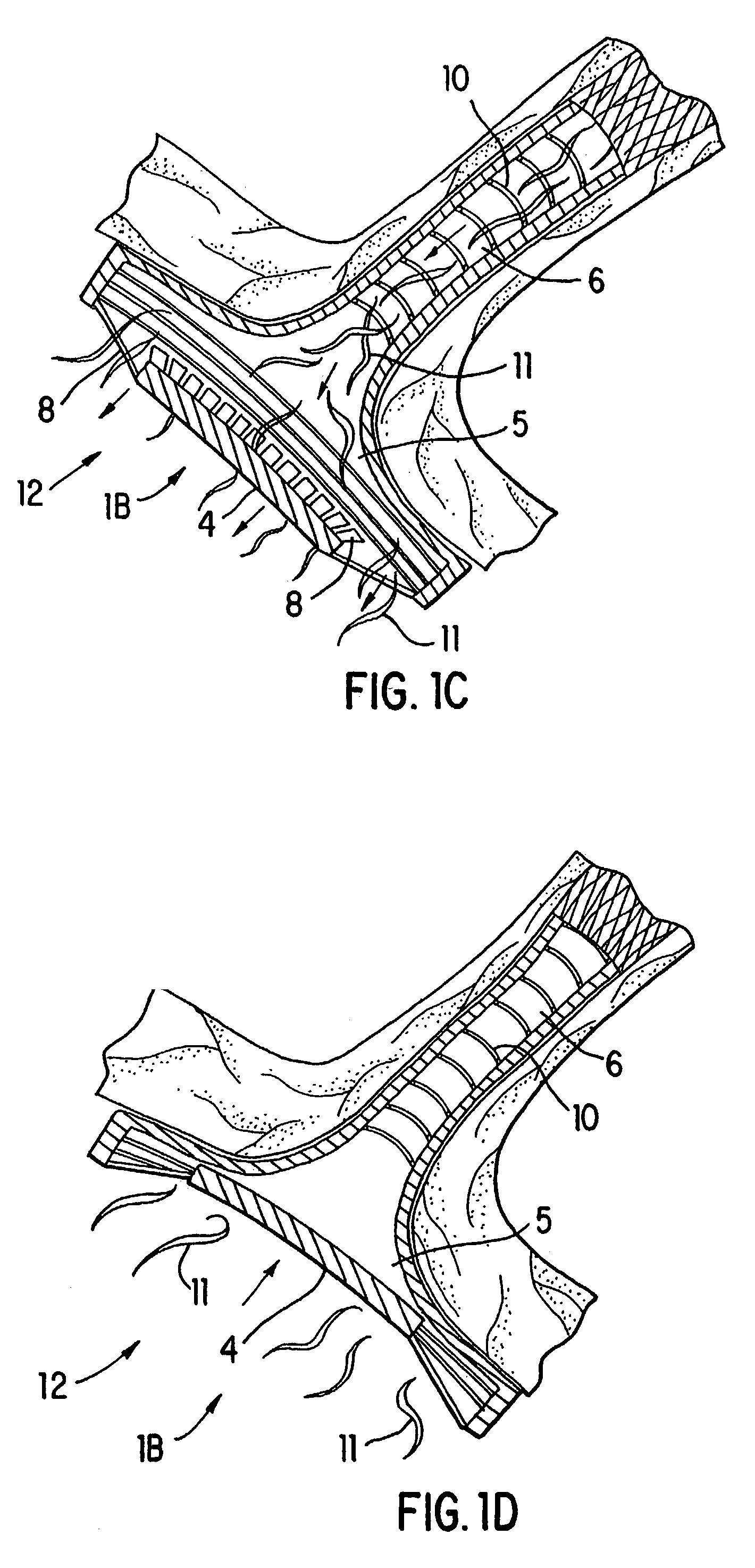 Method and devices for decreasing elevated pulmonary venous pressure