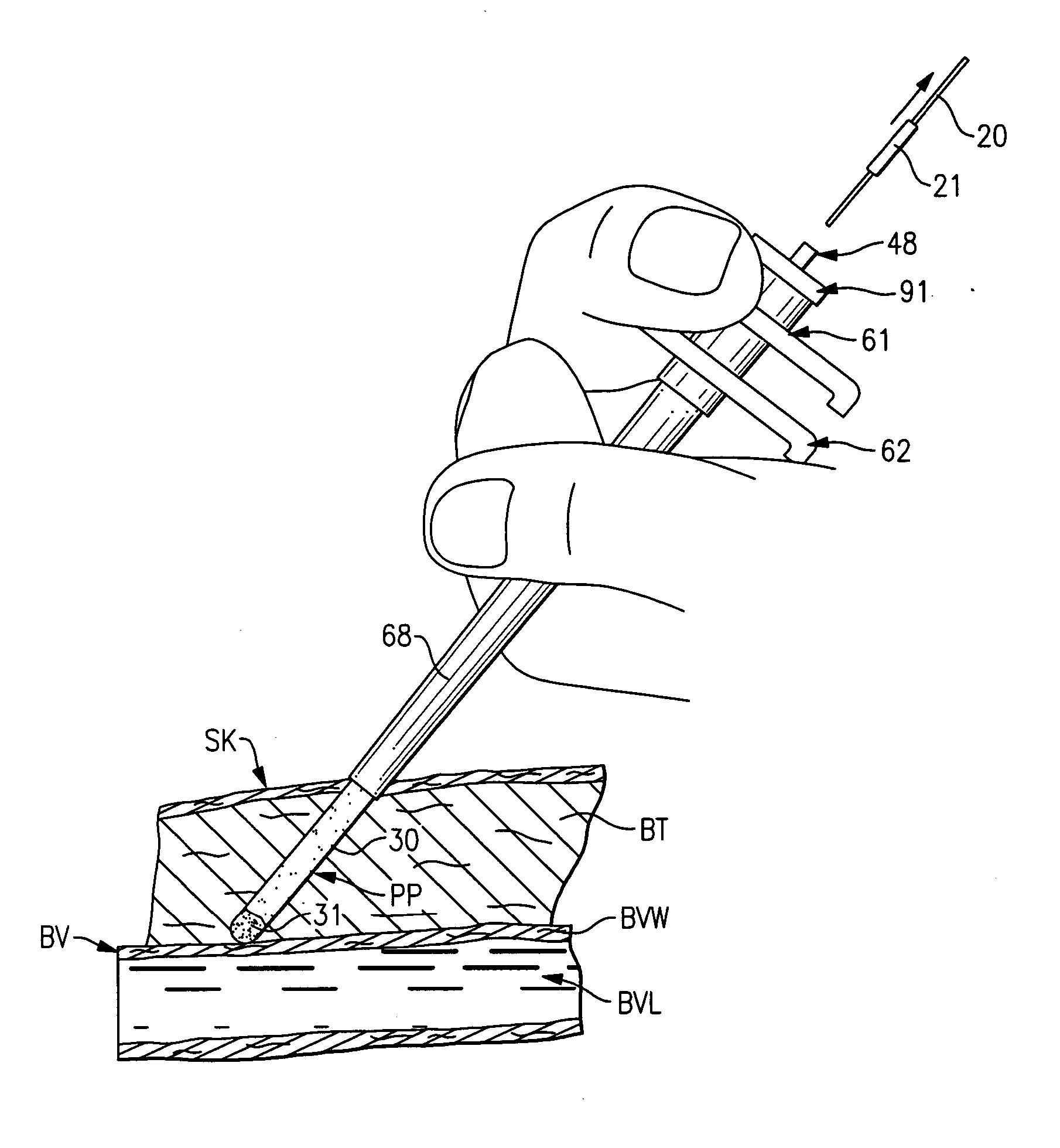 Percutaneous puncture sealing system
