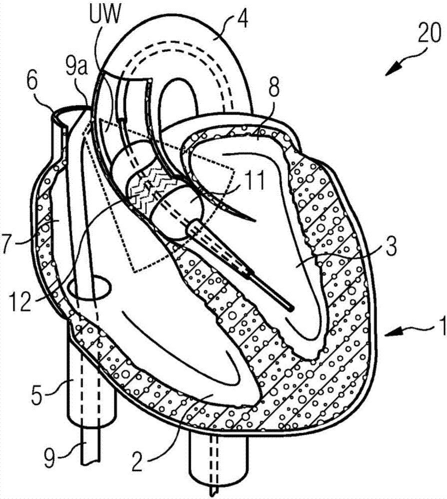 Arrangement For Monitoring A Positioning Of A Prosthetic Cardiac Valve And Corresponding Method