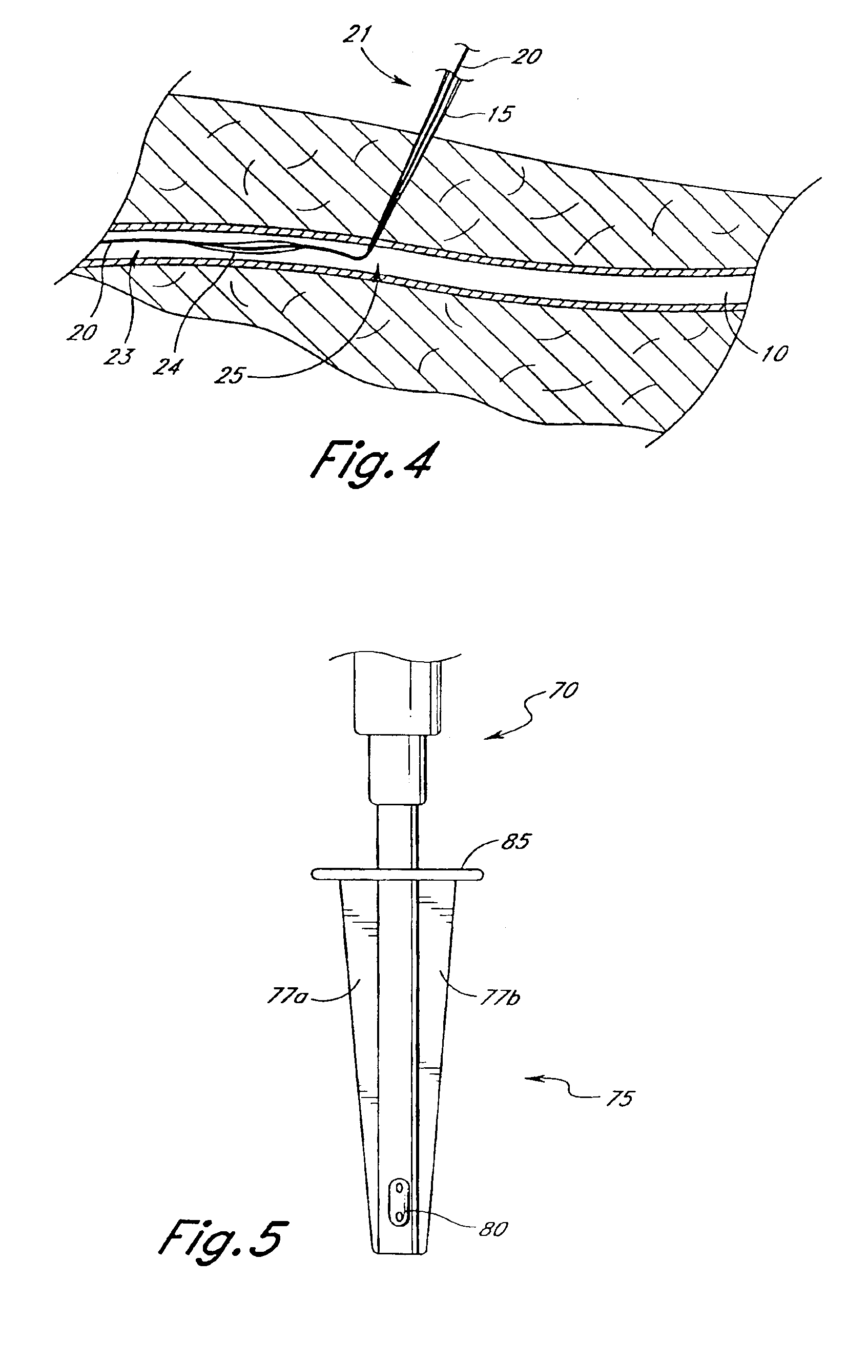 Tissue opening locator and everter and method