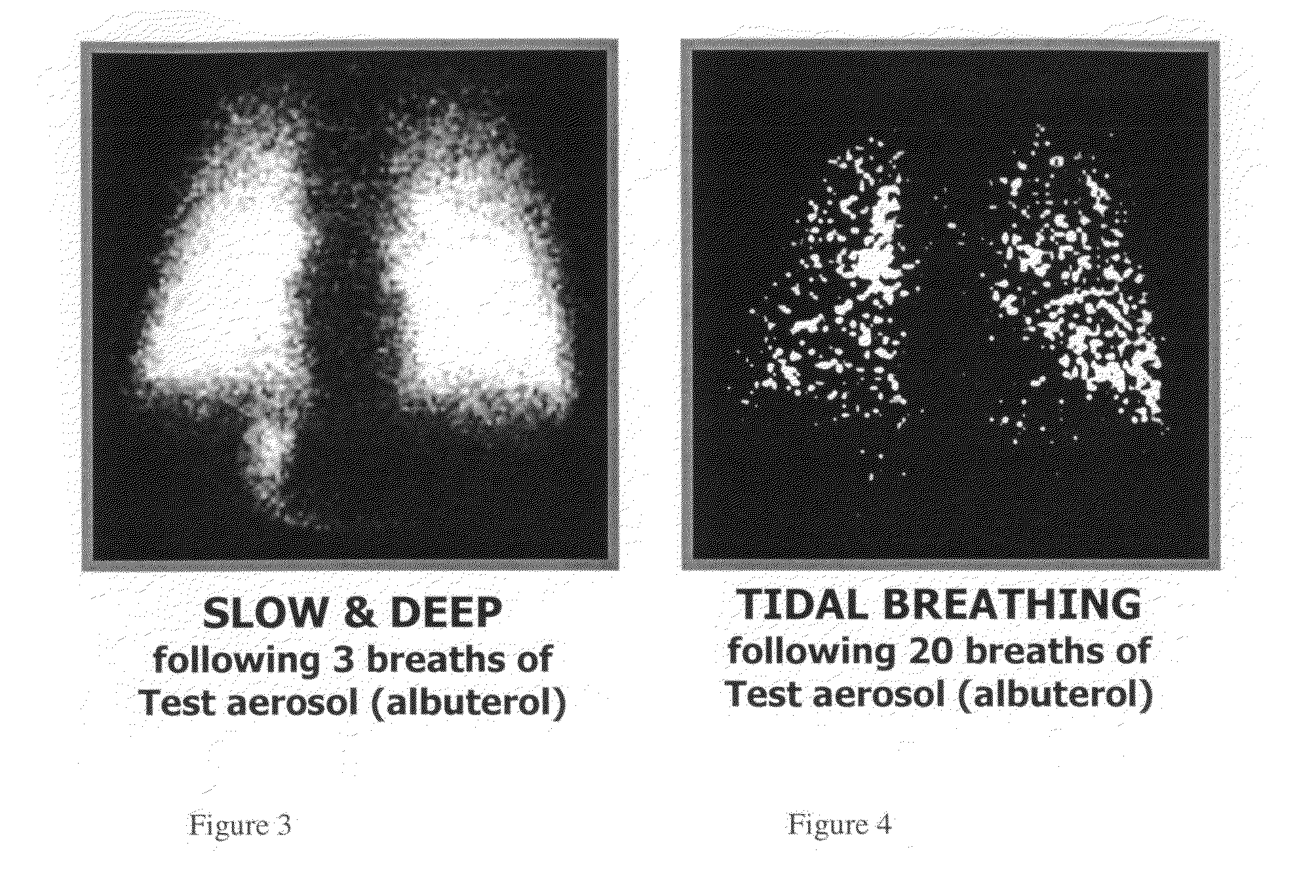 Method of treating tuberculosis with interferons