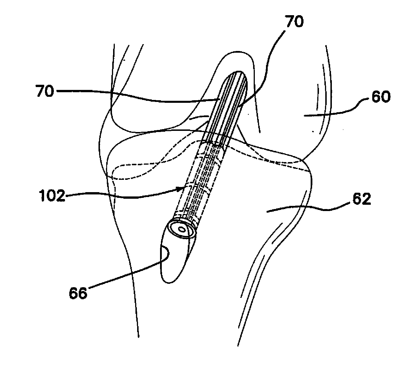 Methods and systems for material fixation