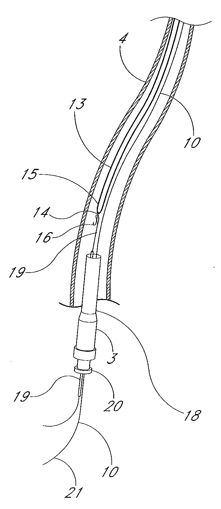Apparatus and methods for transferring an implanted elongate body to a remote site