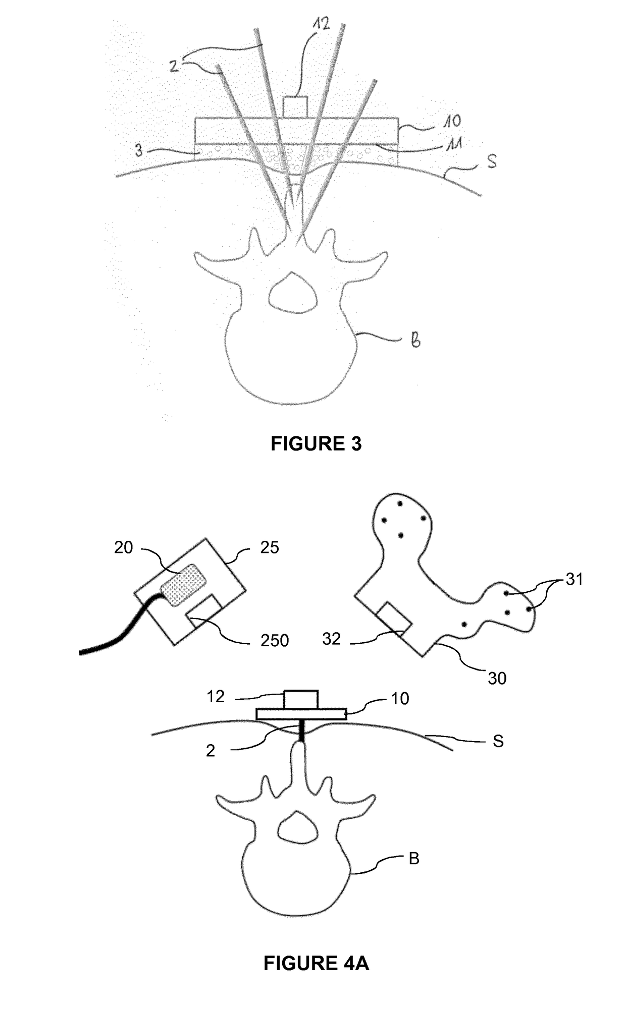 Device for minimally invasive attachment of a tracker and/or a registration phantom to a patient's bone
