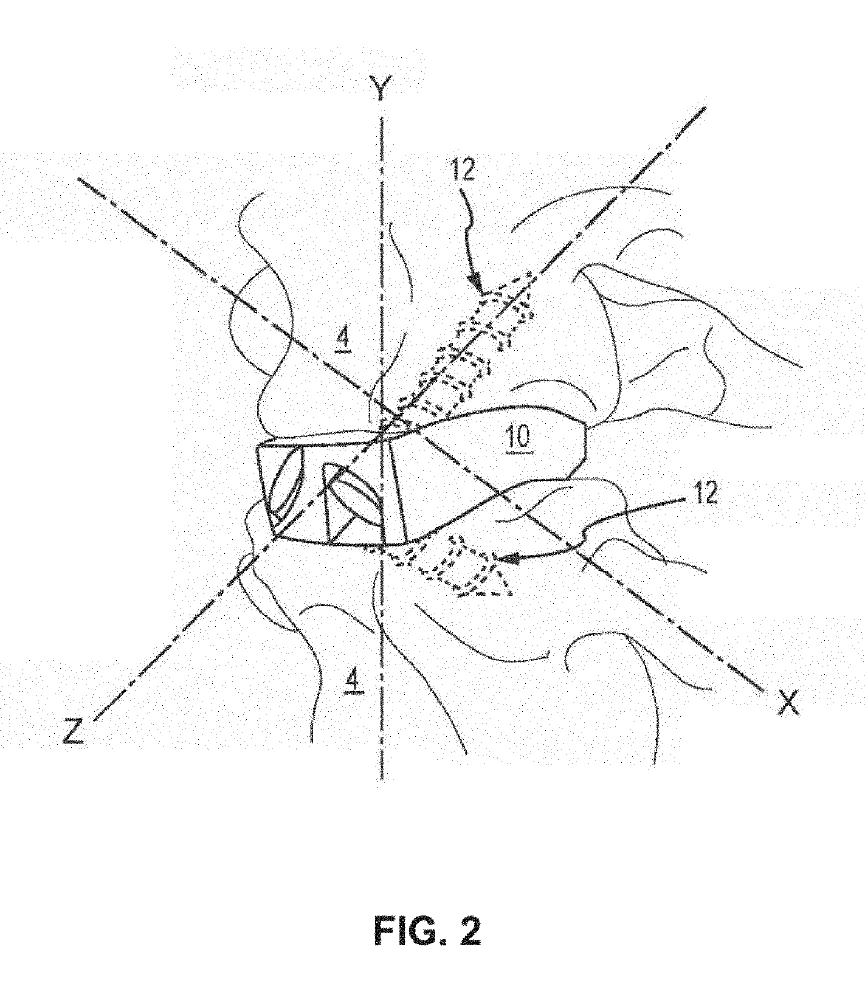 Acif cage, cage system and method