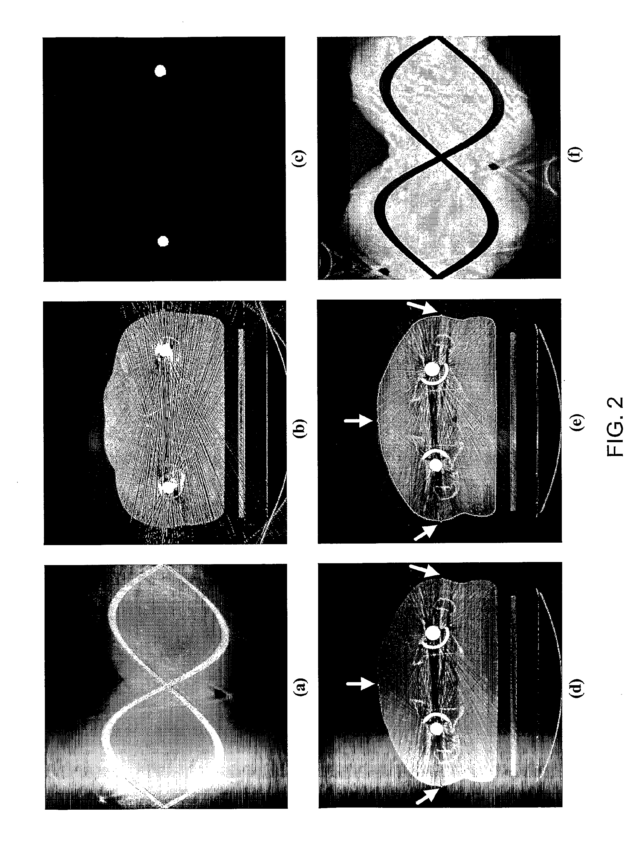 Method and apparatus for metal artifact reduction in computed tomography