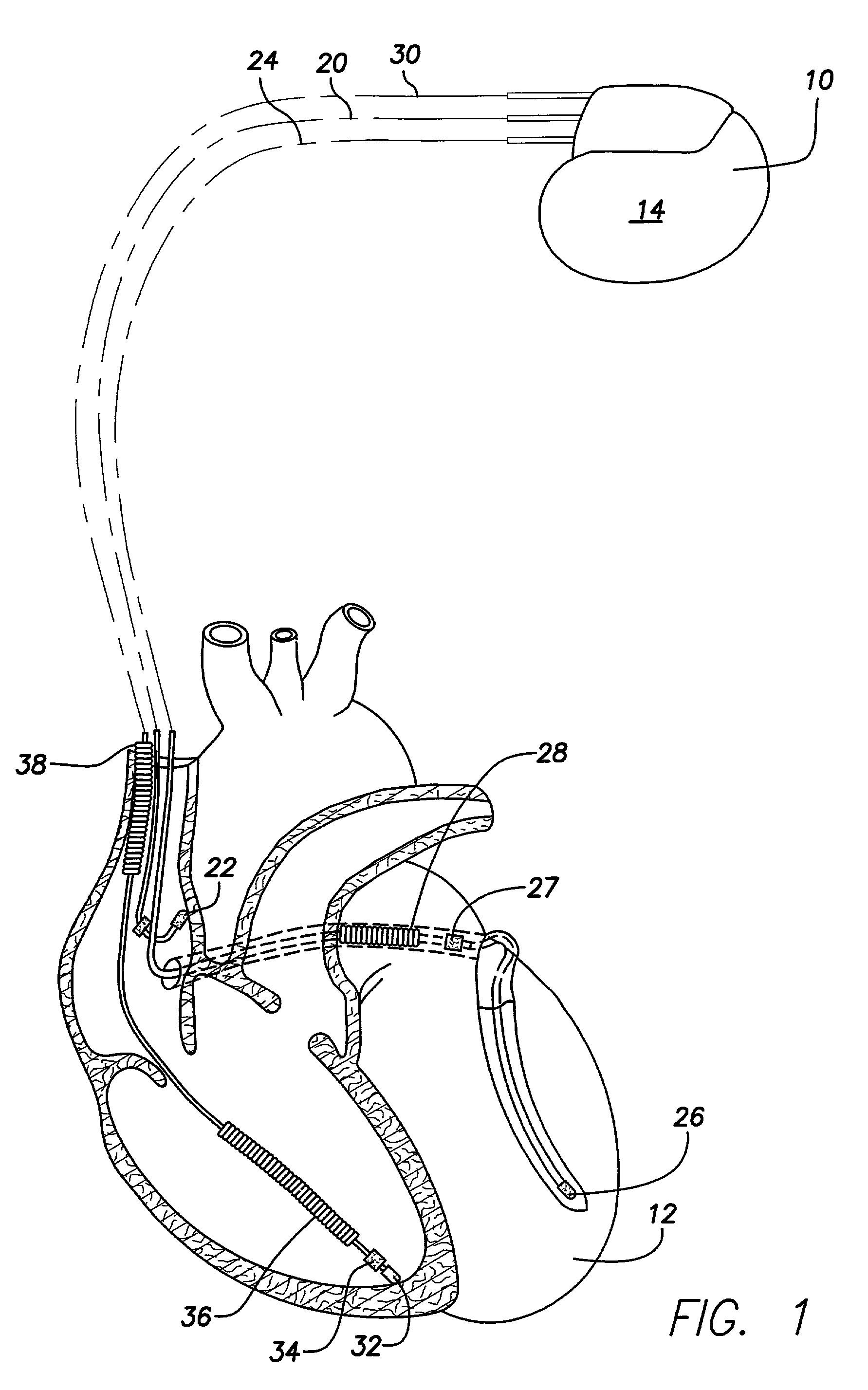 Implantable medical device construction using a flexible substrate