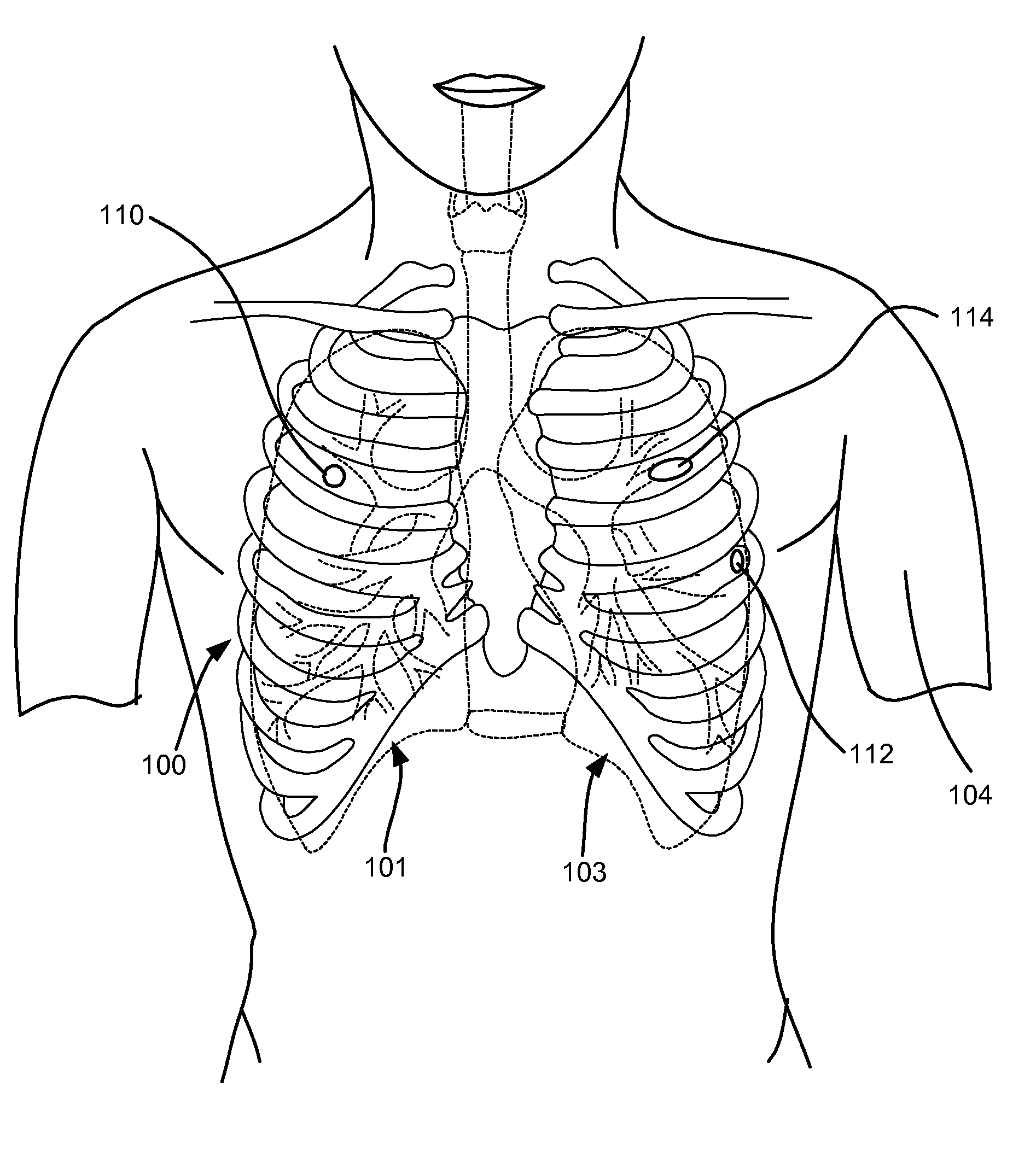 Surgical instruments for creating a pneumostoma and treating chronic obstructive pulmonary disease