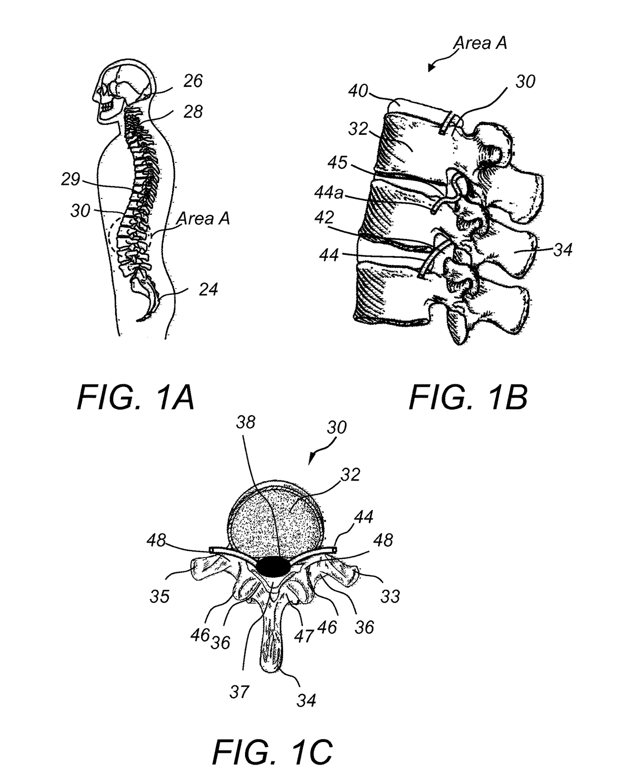 Interspinous fixation implant