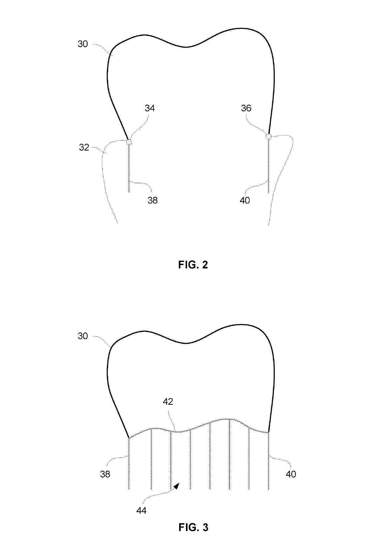Systems and methods for fabricating dental appliances or shells