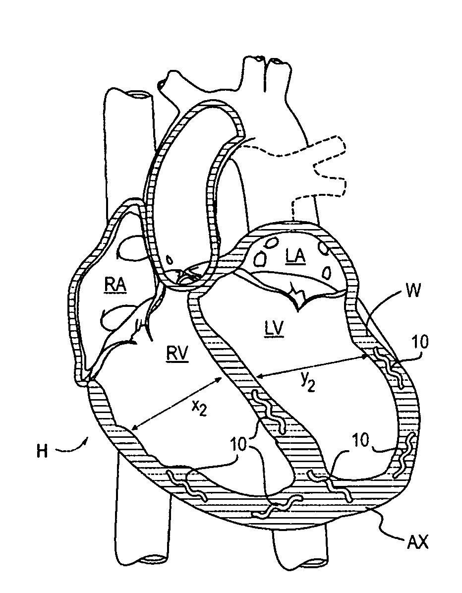 Shape memory devices and methods for reshaping heart anatomy
