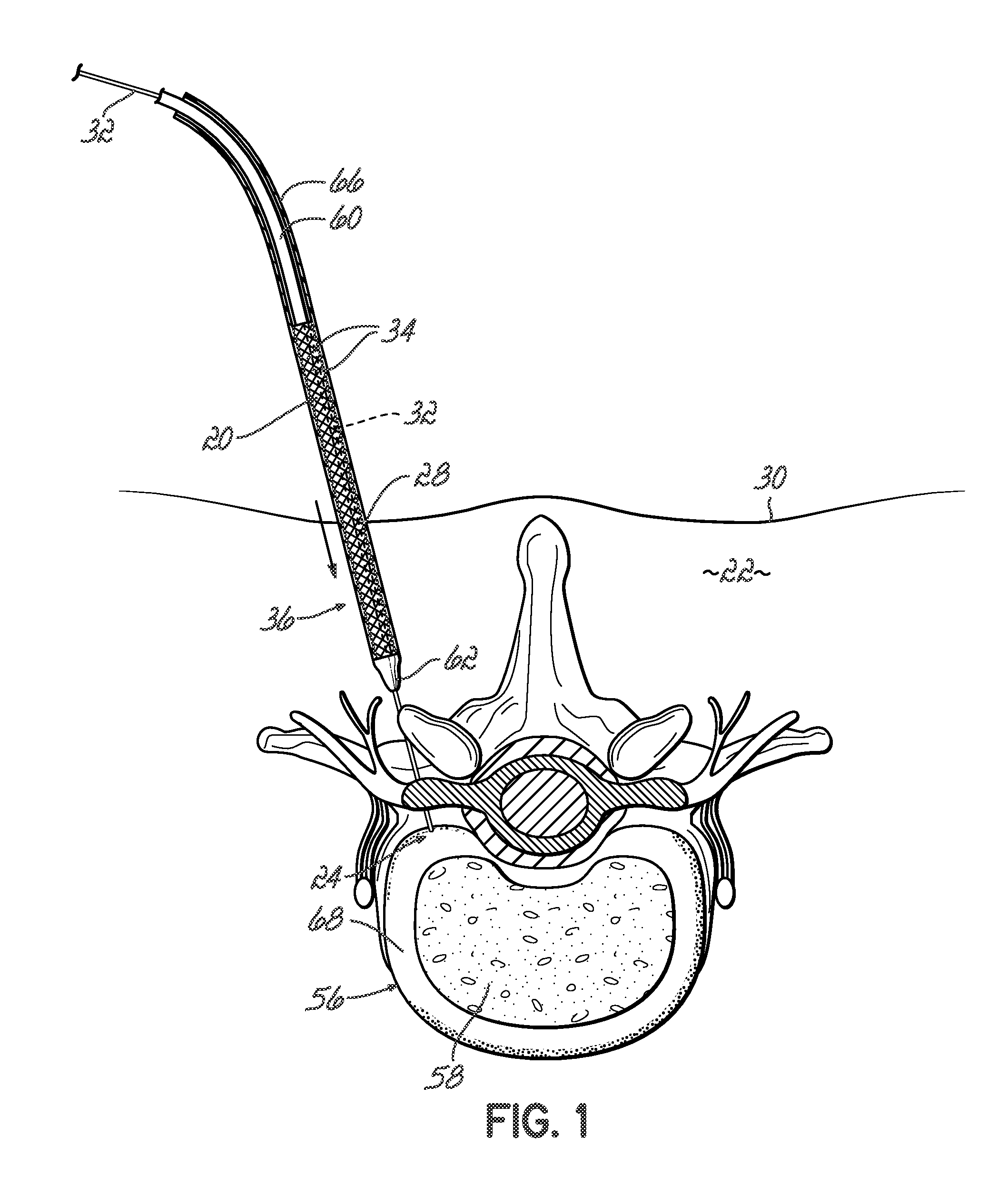 Surgical site access system and deployment device for same