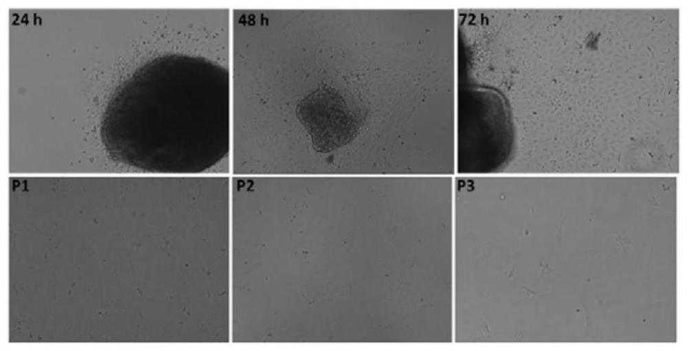 Reversible immortalized II-type alveolar epithelial cell as well as construction and application thereof