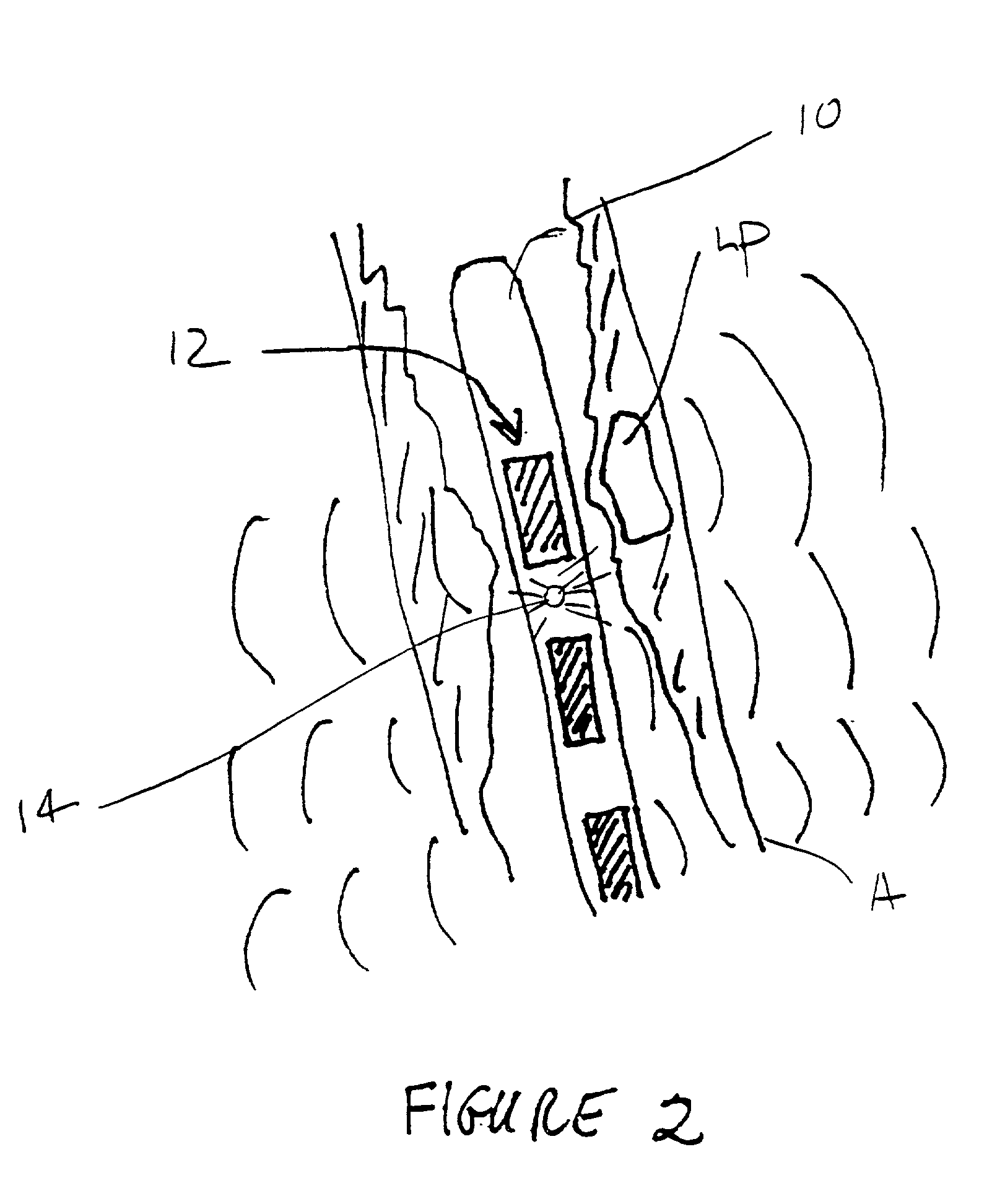 Methods, systems, and kits for plaque stabilization