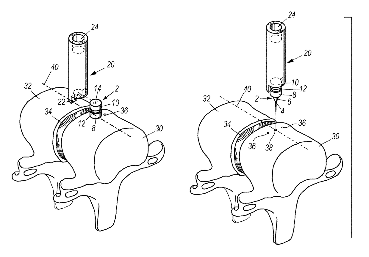 Spinal marker system and methods of use