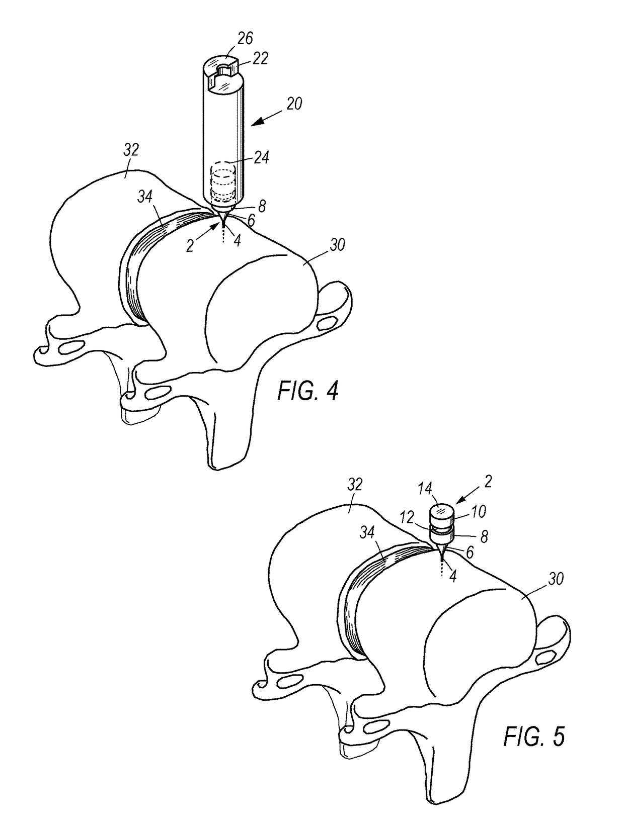 Spinal marker system and methods of use