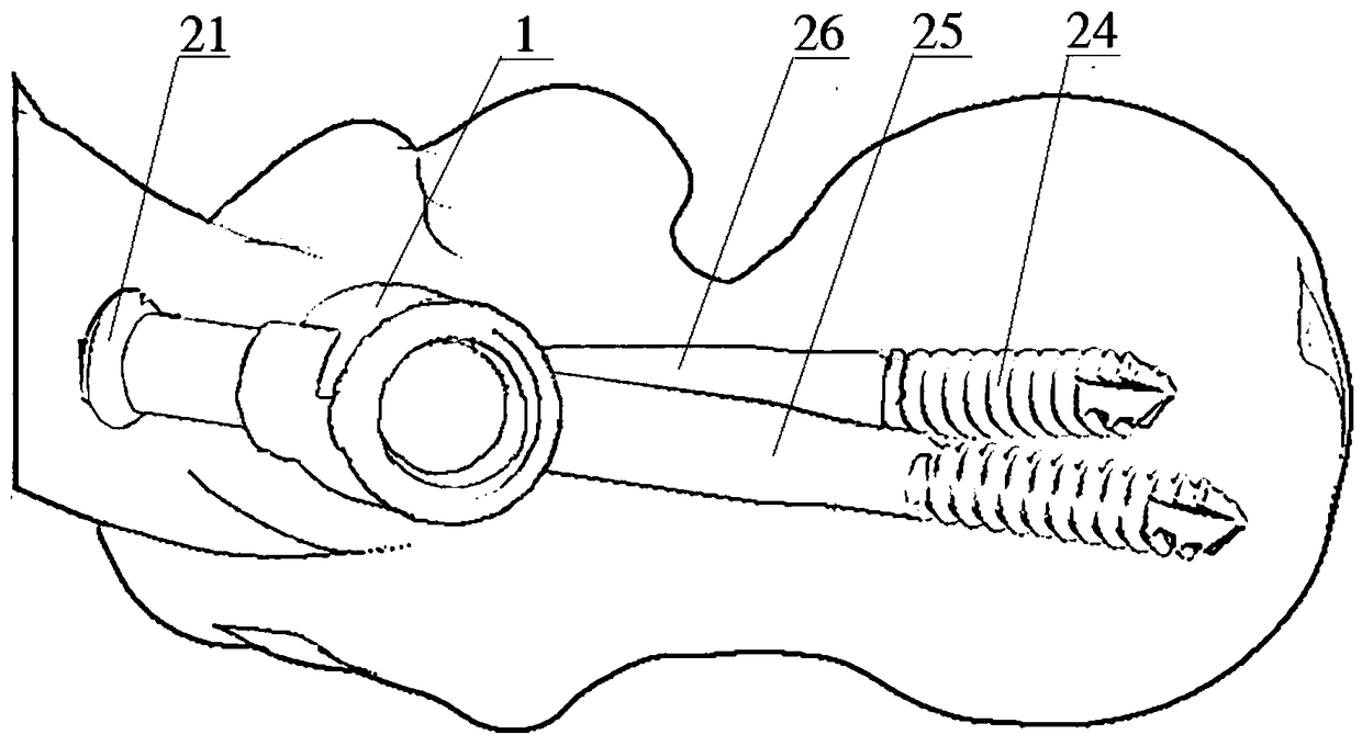 Proximal femoral cross-locking type intramedullary nail