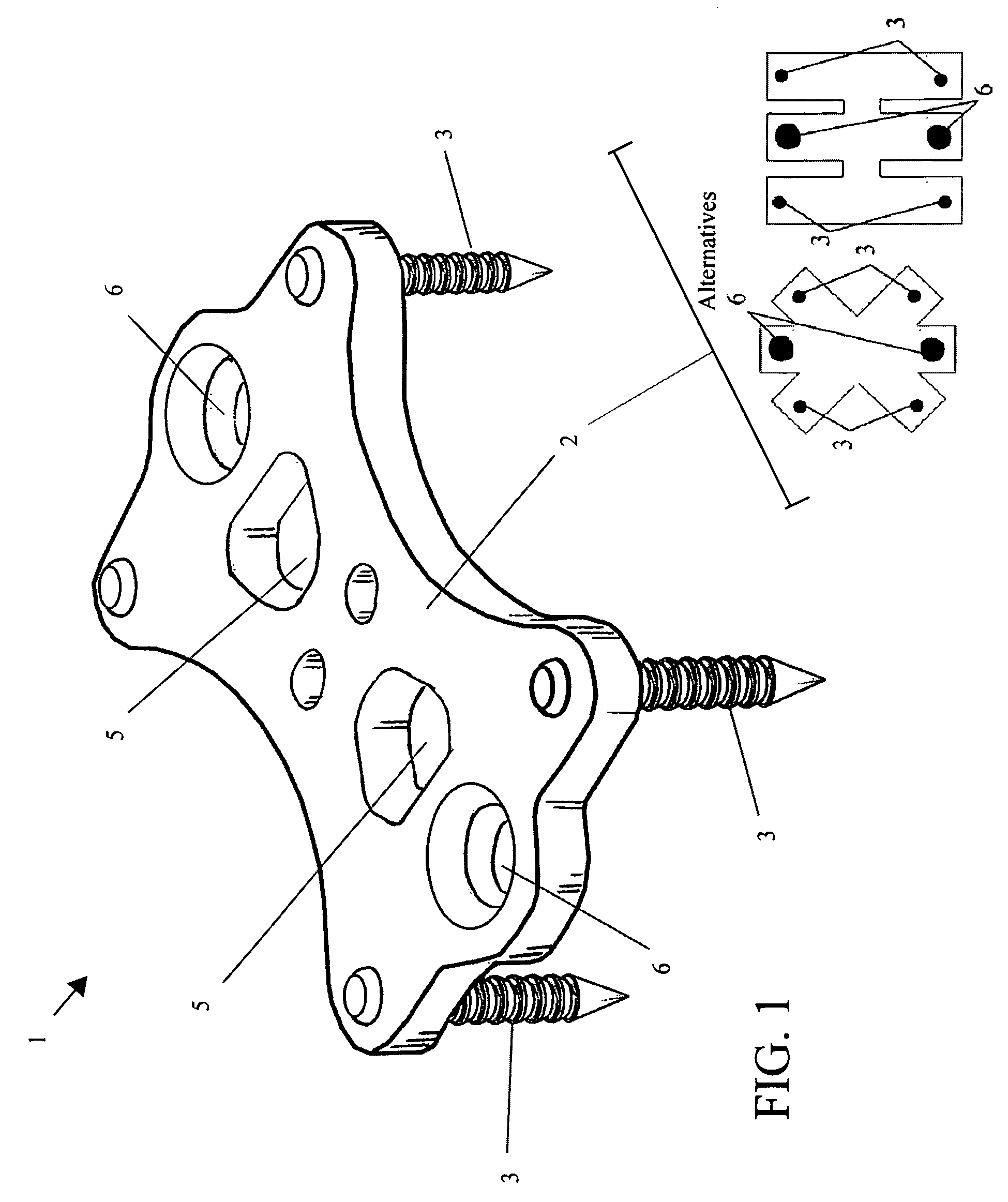 Anterior cervical staple