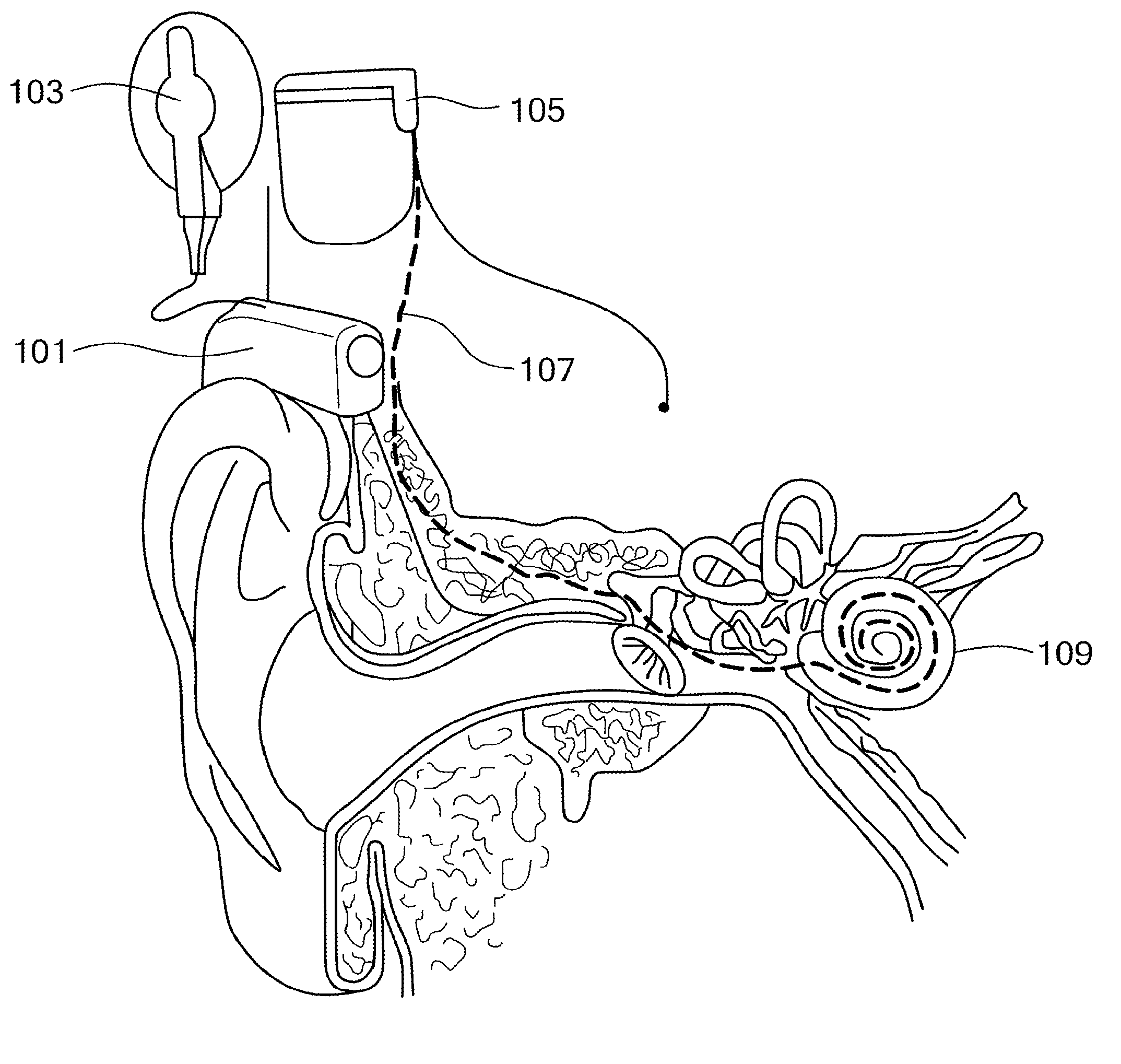Cochlear implant stimulation with variable number of electrodes