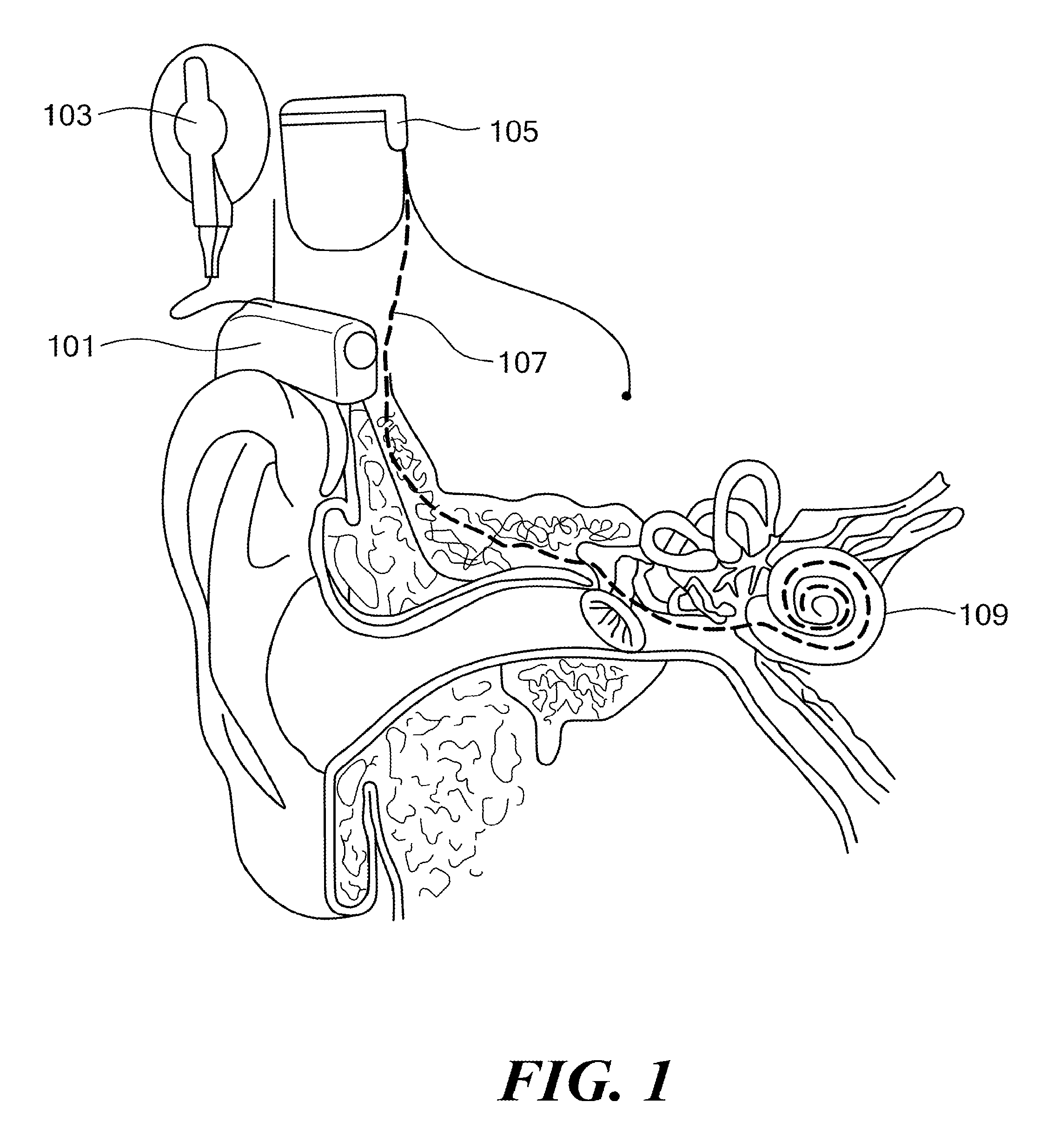 Cochlear implant stimulation with variable number of electrodes