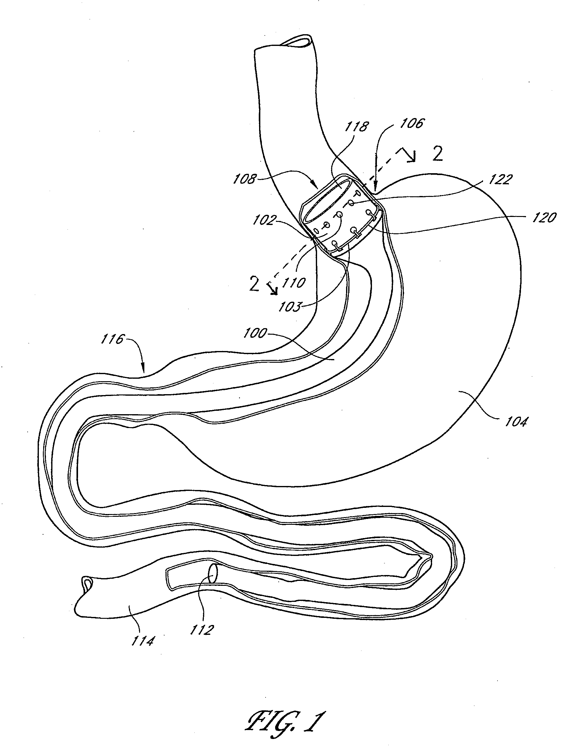 Devices and methods for endolumenal gastrointestinal bypass